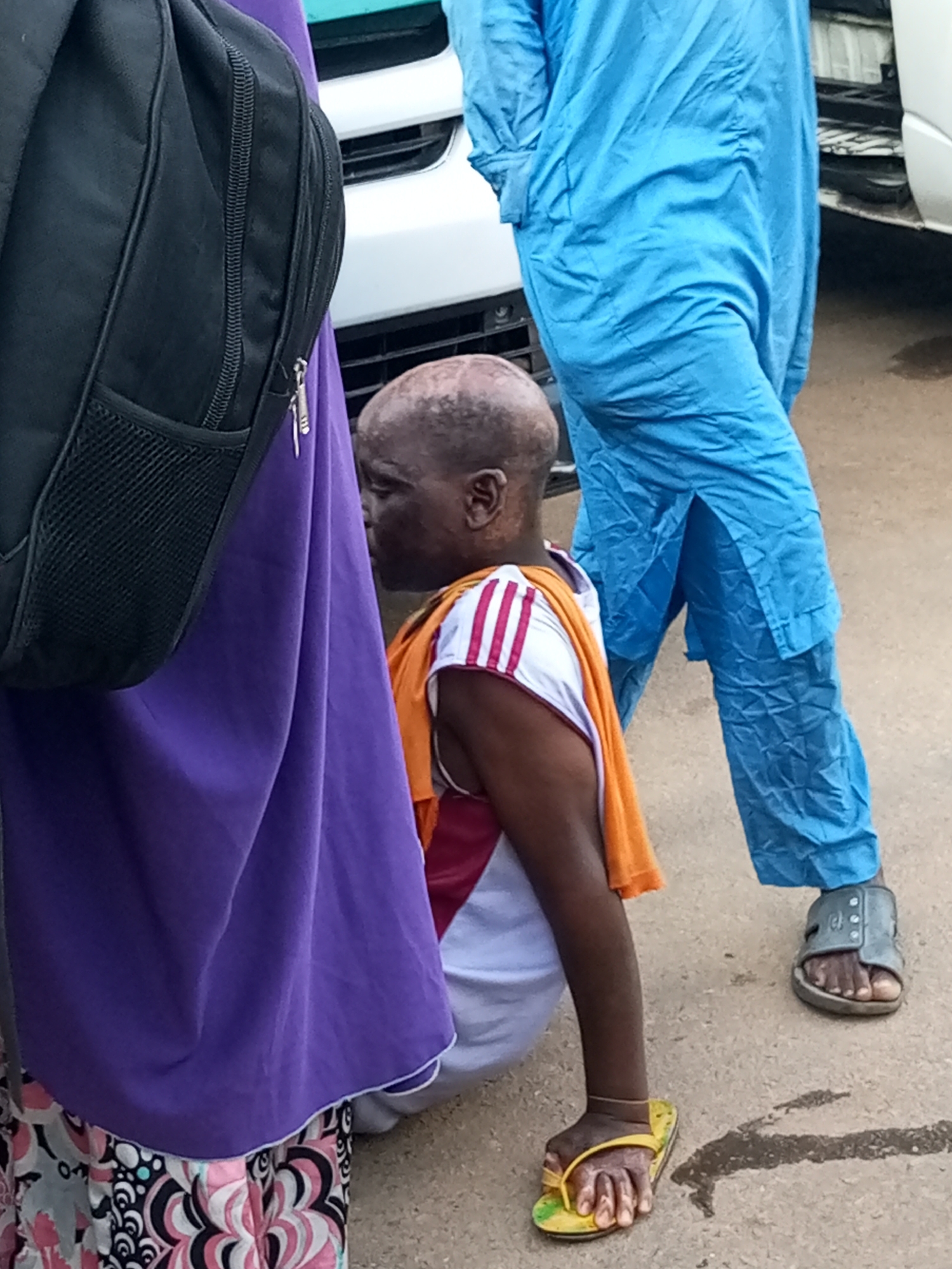 In the city of Gombe, Nigeria, a person with a shaved head and visible skin condition is crouched down, partially obscured by a person wearing a bright purple garment and a black backpack. The crouched individual is wearing a white shirt with red and white stripes on the sleeves and an orange cloth draped around their shoulders. They have a yellow flip-flop on their left foot. To the right, another person is standing, wearing a blue, loose-fitting traditional outfit. Their right foot is visible, clad in a gray sandal. The ground appears to be paved with asphalt. The overall scene suggests an outdoor urban environment, possibly a street or public space.
