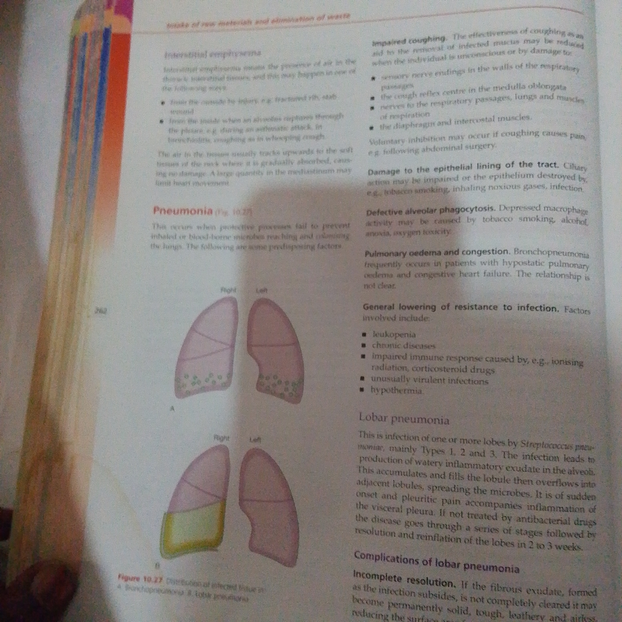 The image is a page from a textbook, likely about biology or medicine. It contains text and diagrams related to respiratory diseases. The text discusses conditions like interstitial emphysema, pneumonia, and lobar pneumonia, detailing their causes, symptoms, and potential complications. There are also two diagrams illustrating the distribution of infected tissue in the lungs, labeled A and B, with indications for "Right" and "Left" lungs. The image does not depict any scene in Jalingo, Nigeria, nor does it contain any elements that would allow for a forensic description of a location or event.