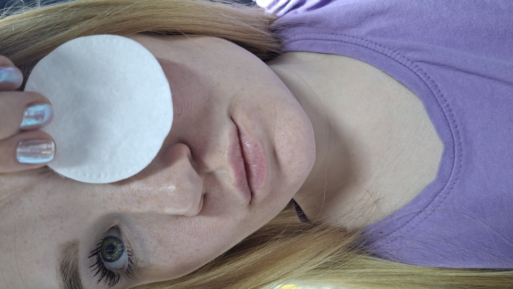 A fair-skinned woman with freckles is lying down, wearing a lilac shirt. She is holding a white cotton pad over her left eye. Her fingernails are painted with an iridescent polish. The location of the image is not discernible as being in the city of Chaikovsky, Russia.