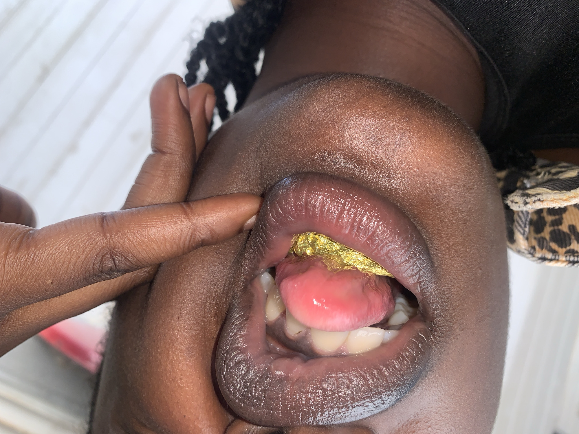 A close-up, vertically oriented image captures the lower facial area of a person with dark skin, focusing on their opened mouth. A dark-skinned hand, with one finger, appears to be holding the upper lip to maintain the mouth's open position. Inside the mouth, a pink tongue is visible, alongside several white teeth. A crinkled, highly reflective golden object is positioned within the mouth, in contact with the right side of the tongue and inner cheek. The person's lips are full and have a dark, glossy, reddish-purple hue. Braided dark hair is partially visible on the upper right, and a dark garment, possibly a shirt, is seen at the lower right. A patterned fabric, resembling an animal print, is visible at the lower left. The background is out of focus, appearing as a light-colored surface with subtle vertical lines. The specific location of New Stadium, Nigeria, cannot be determined from the visual information present in the image.