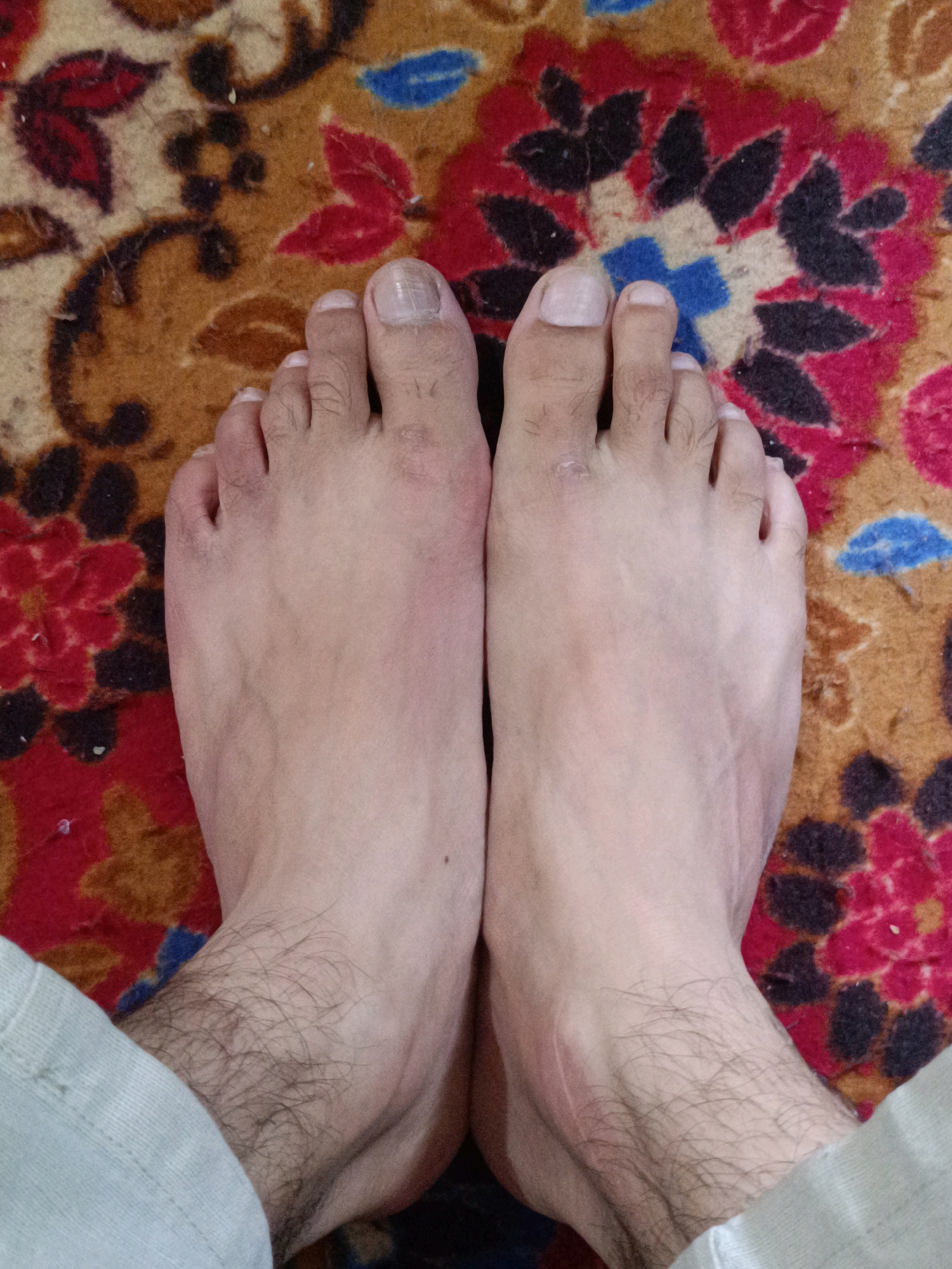 The image shows a pair of bare feet resting on a vibrantly patterned carpet. The carpet features floral motifs in red, black, and blue against a brown background. The feet are positioned side-by-side, with the toes pointing upwards. The skin on the feet appears to be light-toned and shows some minor imperfections, such as small scars or blemishes. The toenails are visible and appear to be trimmed. There is some hair on the lower legs and ankles. The person's clothing, a light-colored fabric, is visible at the bottom edges of the frame, suggesting they are wearing pants or trousers. The overall impression is of a relaxed pose on a domestic setting.
It is impossible to determine the location in the city of Srinagar, India, or any other specific geographical location from this image alone. The image depicts a close-up view of feet on a carpet, and there are no identifying landmarks or contextual clues that would allow for such a determination.