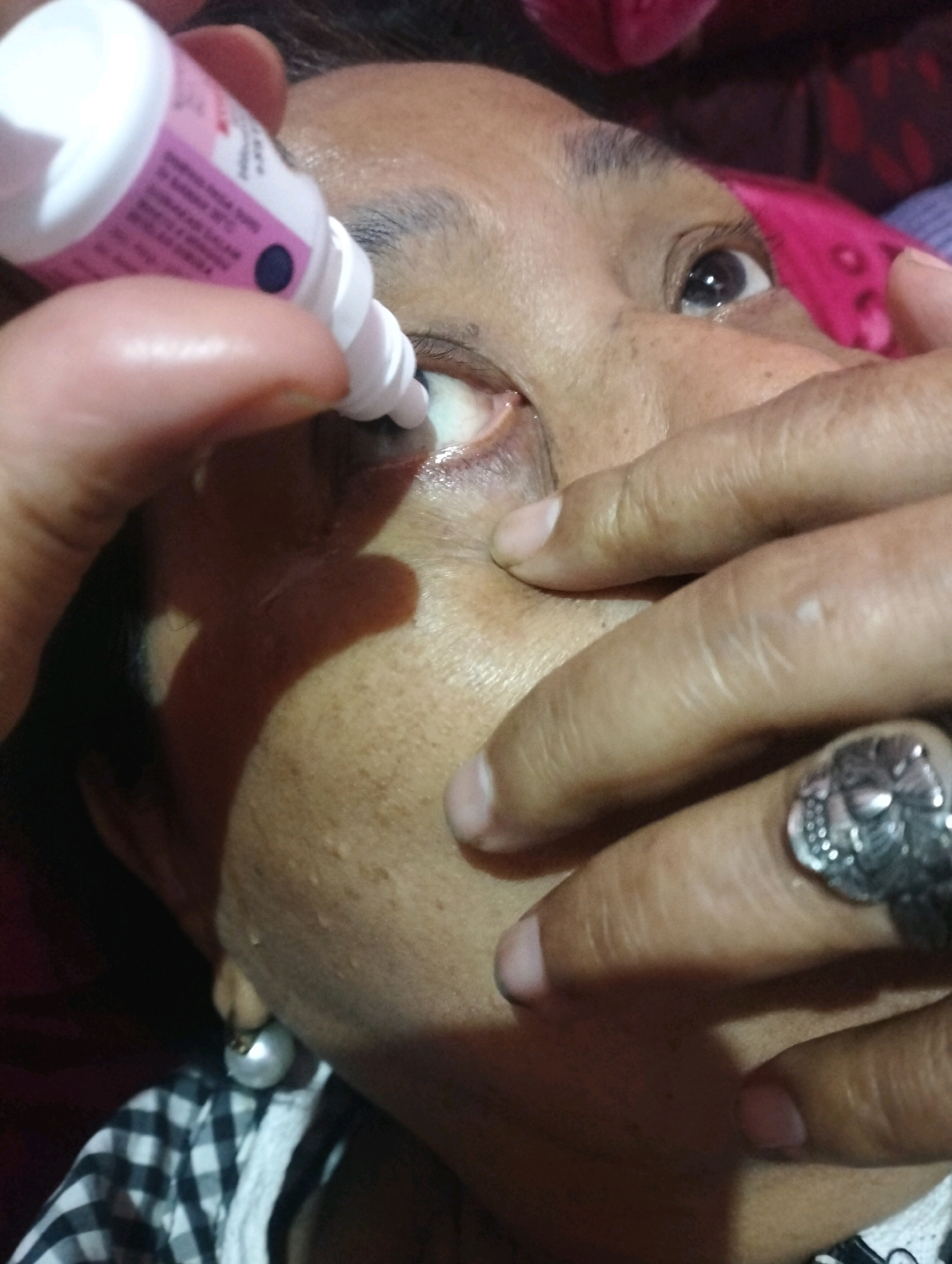 A close-up, medium shot captures a person administering eye drops. The individual's face is partially visible, with one eye open and tilted upwards as a white plastic bottle of eye drops is held over it, with a fingertip gently pulling down the lower eyelid. The person is wearing a checkered shirt and a large, ornate ring with a skull design on their right hand. The background is dark and indistinct, with a hint of pink fabric. The image appears to be taken indoors.