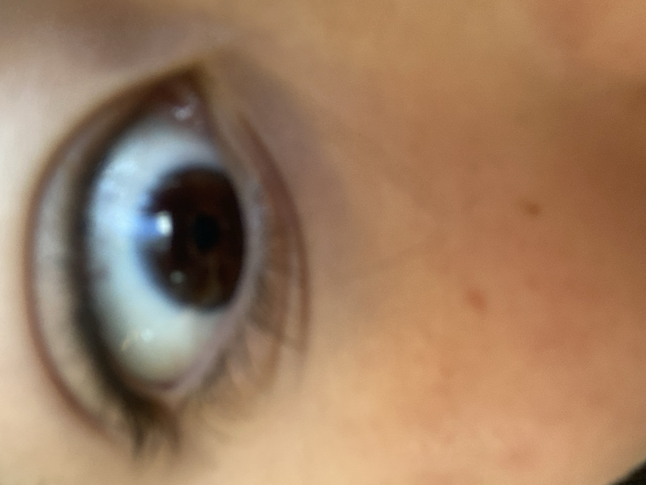The image presents a close-up, slightly out-of-focus view of a human eye and adjacent facial skin. The eye features a dark brown iris with a dilated black pupil reflecting a bright, bluish-white light source. The sclera is white, showing faint capillaries, and dark eyelashes are visible along the upper and lower eyelids. The visible skin below the eye is of a light to medium tone, exhibiting minor freckles. The shallow depth of field renders the skin below the eye significantly blurred. No specific actions, interactions, or discernible environmental features are present beyond the immediate subject. This scene is located in the city of Miami, United States of America.