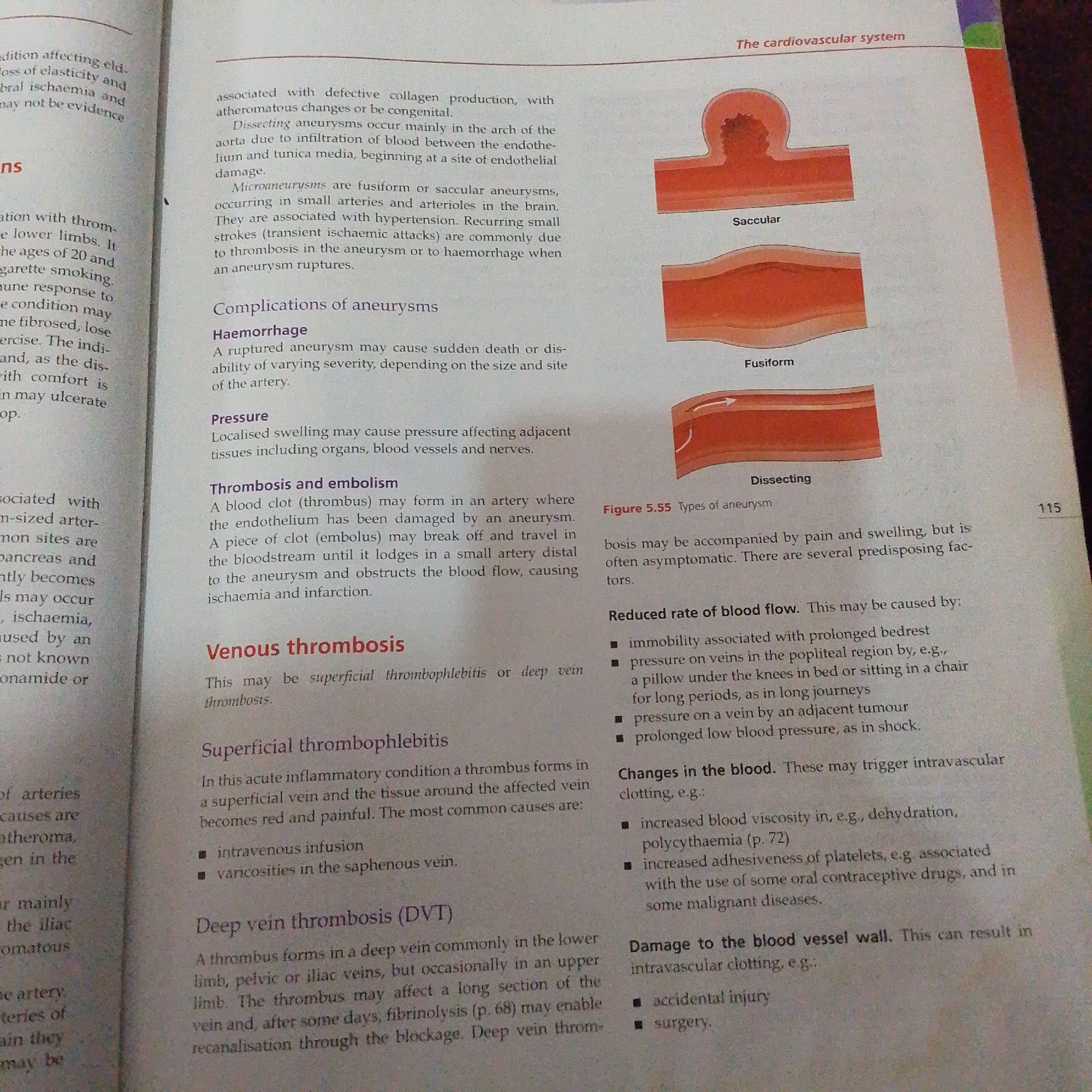 The image displays a page from a medical textbook, likely focused on the cardiovascular system. The page is filled with text, accompanied by three diagrams illustrating different types of aneurysms: saccular, fusiform, and dissecting. The text discusses various conditions related to blood vessels, including aneurysms, thrombosis, and embolism.
The diagrams are simple, line-based illustrations showing the abnormal widening or bulging of arteries. The saccular aneurysm is depicted as a pouch-like protrusion, the fusiform as a spindle-shaped dilation, and the dissecting aneurysm shows a tear within the artery wall.
The text describes the causes, complications, and types of these conditions. It mentions "defective collagen production," "hypertension," and "endothelial damage" as potential causes. Complications discussed include "haemorrhage," "pressure" on surrounding tissues, and "thrombosis and embolism." The section on "Venous thrombosis" differentiates between superficial and deep vein thrombosis, listing common causes for each. A subsection on "Reduced rate of blood flow" and "Changes in the blood" outlines factors that can contribute to intravascular clotting, such as immobility, dehydration, and certain medications. Finally, "Damage to the blood vessel wall" from injury or surgery is also mentioned as a cause of clotting.
The page is numbered "115" and includes a caption for Figure 5.55. The overall impression is one of an educational resource providing detailed information on vascular pathology. There are no people or distinct outdoor settings visible. The focus is entirely on the printed content and anatomical diagrams.