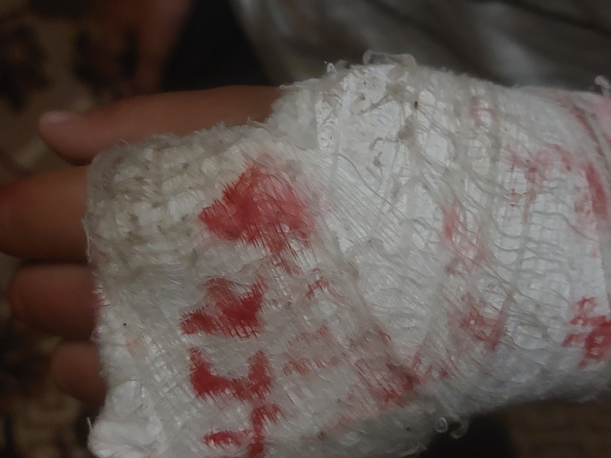 The image shows a hand wrapped in a dirty white bandage with red stains. The location in Tsarevo, Bulgaria is unknown.