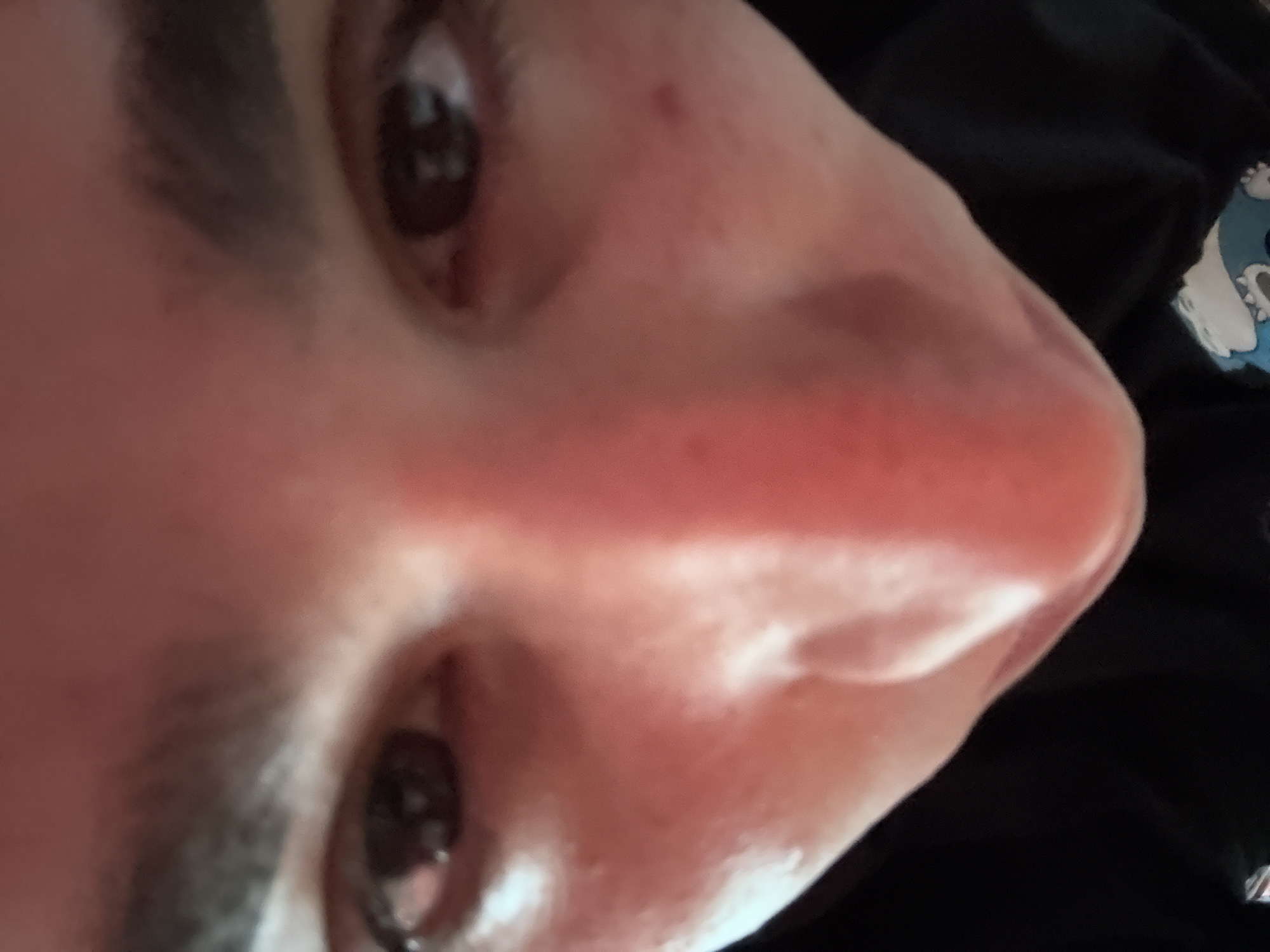 A close-up, slightly angled view of a person's face. The individual's nose is prominent in the foreground, exhibiting a reddish tone. Two eyes are visible, with dark irises. Above the eyes, a small portion of dark eyebrows can be seen. The background is dark, with a small patch of a cartoon image on fabric visible towards the upper right corner. There are no visible indications of location. No evidence indicates this photo was taken in Elhovo, Bulgaria.