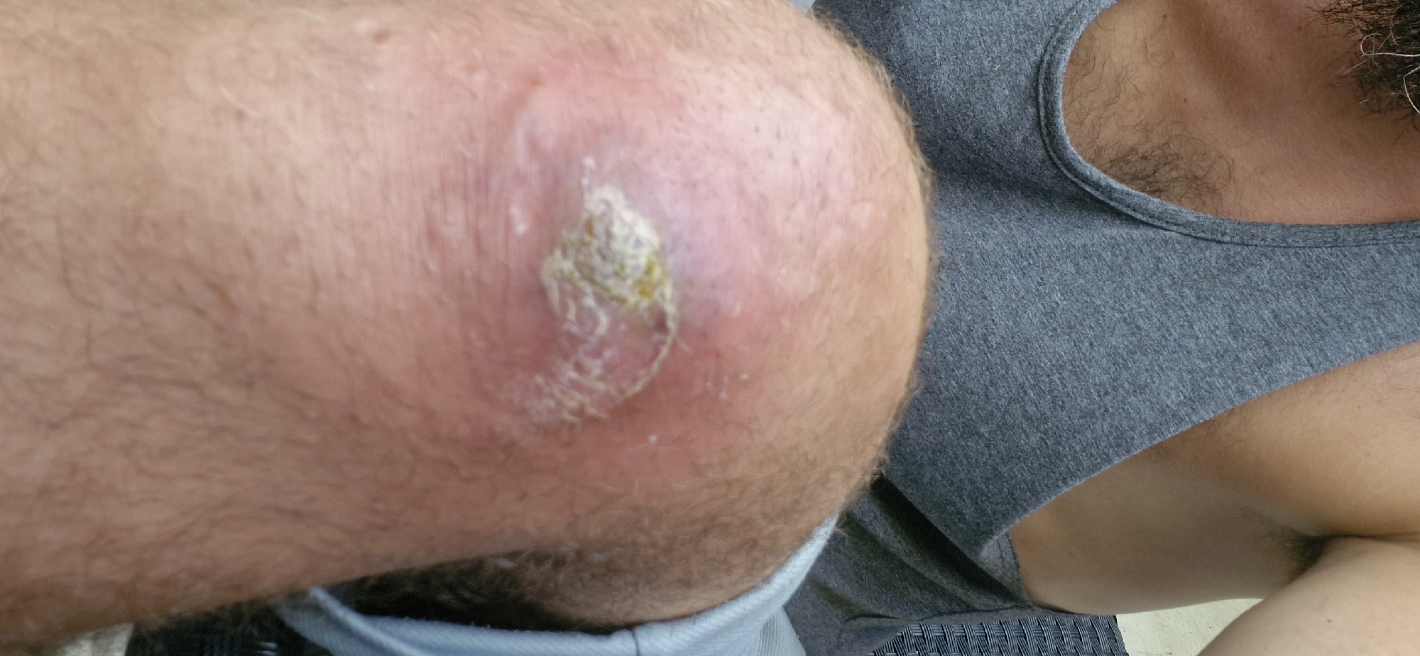 The image shows a close-up of a person's knee with a large, inflamed wound. The wound appears to be infected, with redness and swelling surrounding it, and a yellowish, crusty discharge in the center. The person is wearing a grey tank top. The background is blurred, but appears to be an outdoor setting with a wicker chair visible. The location is Unknown, Unknown.