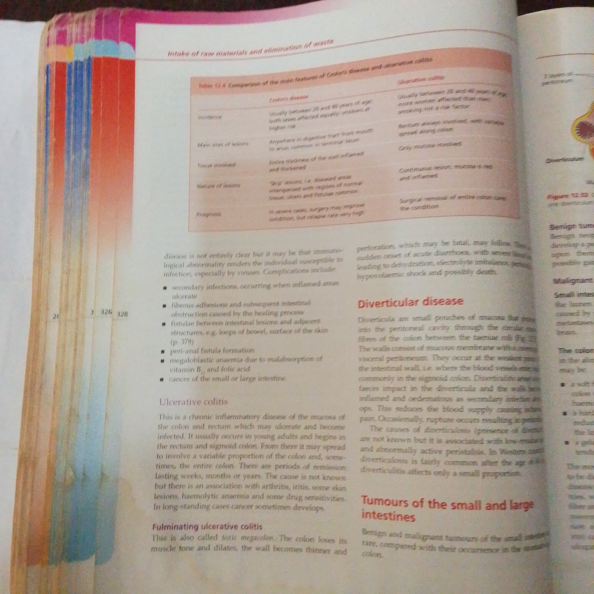The image displays a close-up, angled view of an open textbook, revealing pages with medical information. The left page contains a table comparing Crohn's disease and ulcerative colitis, with columns for "Crohn's disease" and "Ulcerative colitis" and rows detailing "Incidence," "Main sites of lesions," "Tissue involved," "Nature of lesions," and "Prognosis." Below the table, a section on "Ulcerative colitis" is visible, followed by "Fulfminating ulcerative colitis." The right page features headings such as "Diverticular disease," "Tumours of the small and large intestines," and an illustration of diverticula labeled "Figure 12.53." The text is primarily in English, with some medical terminology. The background is blurred, but hints of colorful book bindings suggest it is part of a larger collection of books. There is no discernible information or imagery related to Jalingo, Nigeria, in this image.