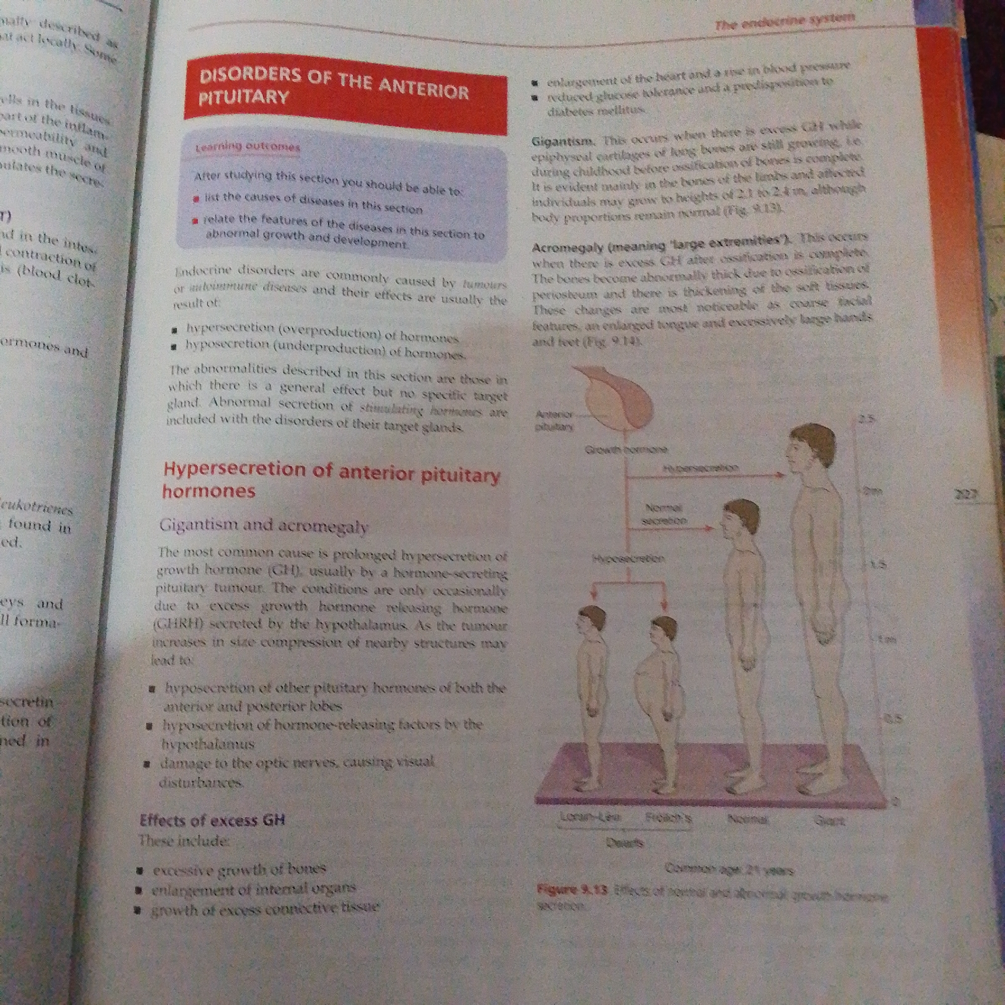 The image is a photograph of a page from a textbook discussing disorders of the anterior pituitary gland. The text is primarily in English and describes conditions such as Gigantism and Acromegaly, which are caused by the hypersecretion of growth hormone. There are also illustrations depicting the effects of these conditions on human body size. The image does not contain any information or visual elements related to the city of Jalingo, Nigeria.