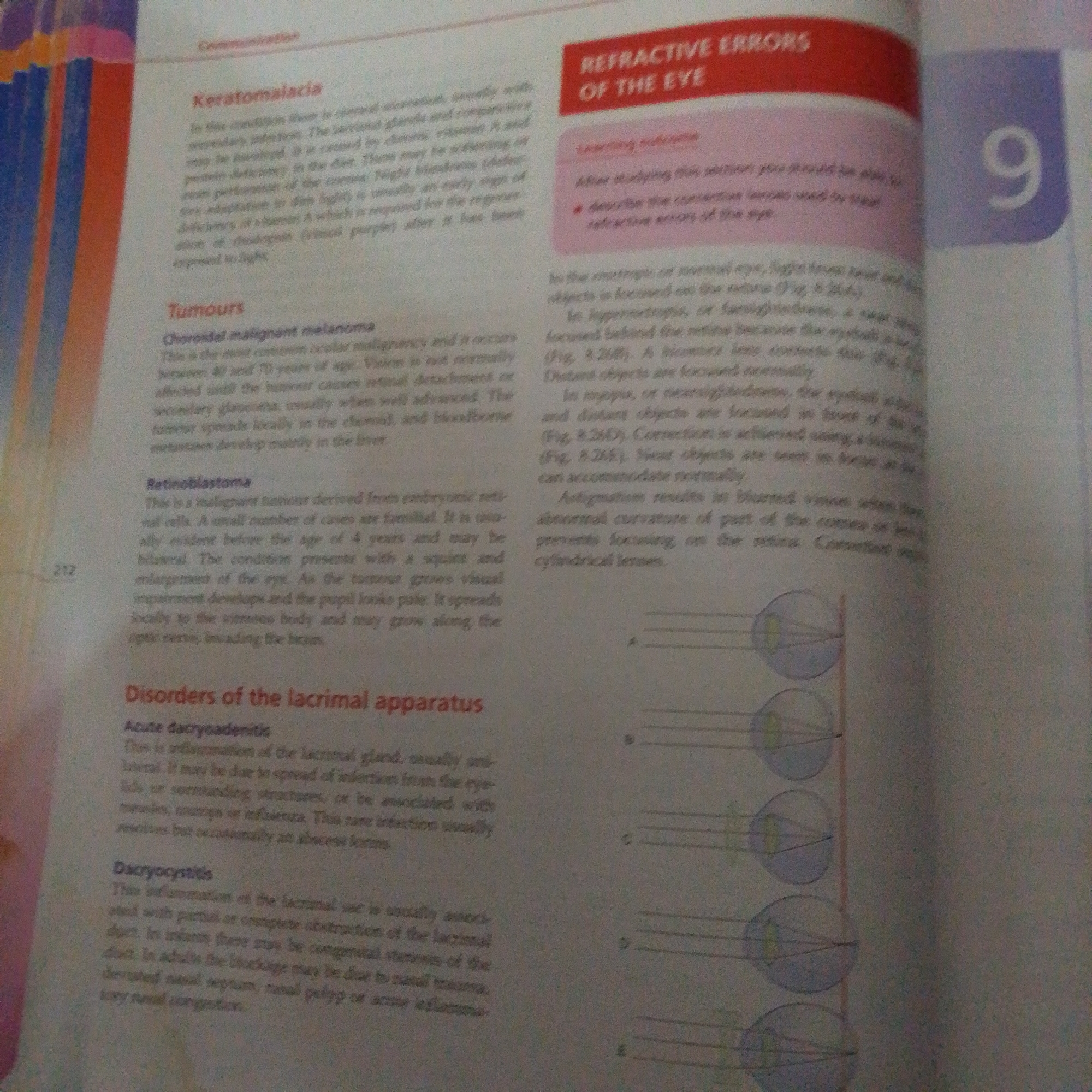The image shows a page from a textbook, likely related to biology or health sciences, with text and diagrams discussing various eye conditions. On the left side, there are headings for "Keratomalacia," "Tumours" (specifically mentioning Choroidal malignant melanoma and Retinoblastoma), and "Disorders of the lacrimal apparatus" (Acute dacryoadenitis and Dacryocystitis). On the right side, there is a section titled "REFRACTIVE ERRORS OF THE EYE" with learning outcomes and explanations of myopia, hypermetropia, and astigmatism, accompanied by diagrams illustrating how light is focused in the eye. The page number "212" is visible on the left side, and a large number "9" is displayed on the far right, possibly indicating a chapter or section number. There are no elements in the image that suggest a location in Jalingo, Nigeria, or any forensic context. The image is purely an educational document.