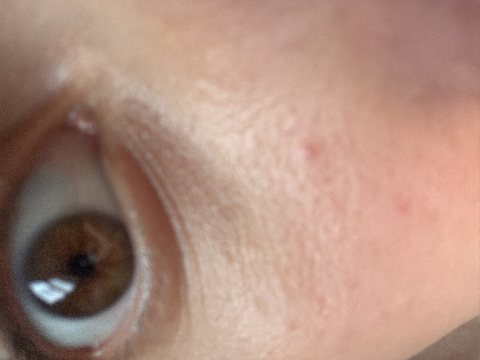 This close-up image features a human eye, specifically the right eye, and the surrounding skin. The subject is a person, with the location context provided as Plovdiv, Bulgaria. The eye has a warm brown iris and a dilated black pupil, within which distinct reflections of a light source are visible, suggesting indoor or artificial lighting. The whites of the eye are visible beneath the iris. The skin around the eye, particularly towards the right and above, exhibits fine lines and pores, along with several small, reddish bumps that appear to be minor blemishes or areas of irritation. The overall image has a soft focus, giving a slightly blurred appearance, especially to the skin. No specific activity or event is discernible beyond the subject being photographed. The expression conveyed by the eye is neutral. There is no visible text in the image.