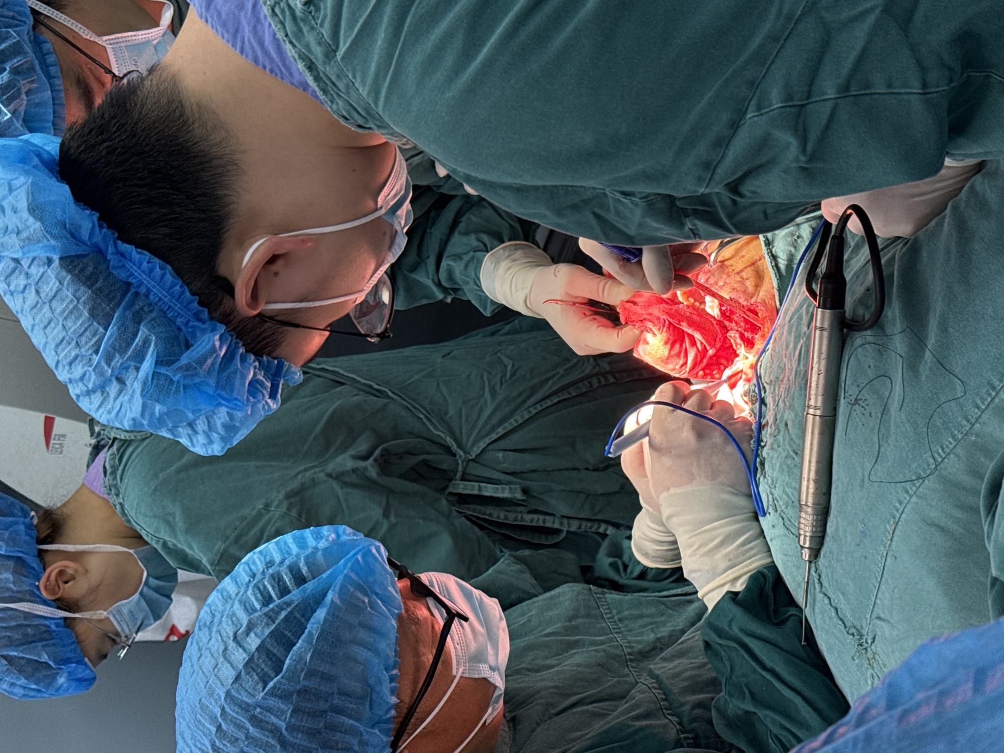 The image depicts a surgical scene with multiple individuals in green surgical gowns and blue surgical caps, masks, and glasses. The foreground shows a surgical field with bright red tissue held by gloved hands. A surgical instrument is positioned on the patient's gown. The location is likely a hospital operating room. There is no definitive indication the location is Yuzhong District, China.