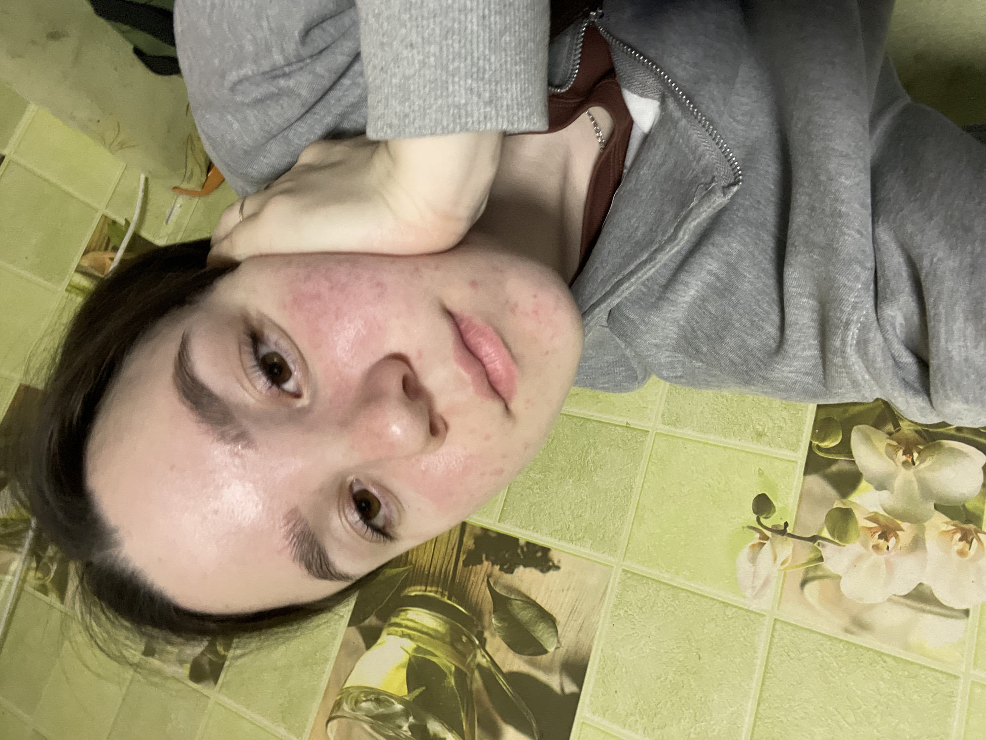 An individual, appearing to be a young female, is depicted in a close-up, slightly upward-angled portrait. She has fair skin, dark brown hair, and dark brown eyes. Visible skin features include redness and multiple small lesions on her cheeks, chin, and forehead. Her eyebrows are dark and full, and her lips are closed. She is wearing a grey zippered hooded sweatshirt over a reddish-brown inner garment, with a thin silver-colored chain necklace visible around her neck. Her right hand supports her chin, with a thin ring present on one finger. The background is composed of light green square tiles. Integrated into the tile pattern are two photographic decorative inserts: one on the left shows white orchid blossoms with green buds, and another in the upper right quadrant depicts a clear glass containing a yellowish liquid and green leaves, resting on a wooden surface. The location in the city of Ольховка, Russia, cannot be determined from the visual content of the image.