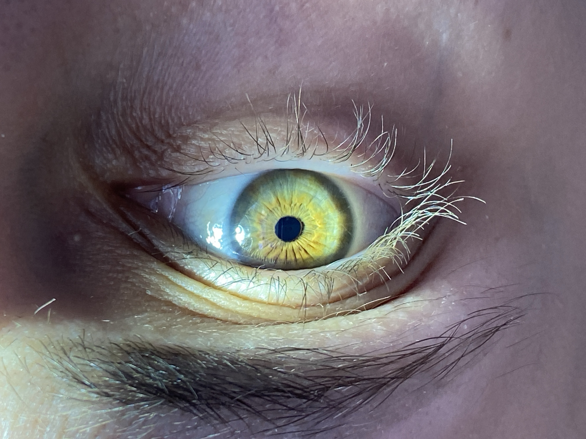 A close-up photograph shows a human eye. The iris is predominantly yellow with a dark pupil. The subject has light-colored eyelashes. A dark eyebrow is visible beneath the eye. The skin around the eye shows wrinkles and texture. There is no contextual information in the image to determine a location, specifically in the city of Chaikovsky, Russia.