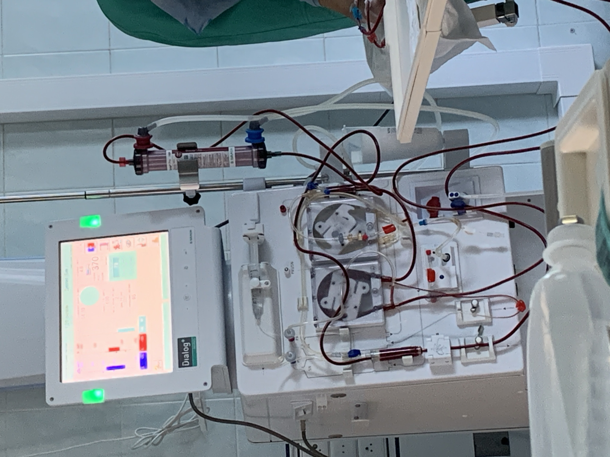 The image shows a dialysis machine in what appears to be a medical setting. The machine has a screen displaying various parameters and several tubes connecting different components. There is a dialyzer positioned horizontally at the top of the machine. The city of Chaikovsky, Russia, is not directly indicated in the image. The objects present include the dialysis machine, tubes, monitor, and associated medical equipment. The environment is likely a medical facility, potentially a hospital or clinic. The scene seems to depict a dialysis procedure or the preparation thereof. No people are fully visible, but a hand or arm is partially visible at the top of the frame.
