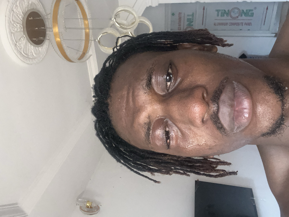 An individual, identified as a male with dark skin and dreadlocks, is depicted in a close-up, head-and-shoulders shot taken indoors in Egbe, Nigeria. He presents with a distressed appearance, characterized by significantly swollen eyelids, particularly the left eye, which is almost completely closed. Both eyes appear watery, and moisture is visible on his forehead, cheeks, and around his mouth, consistent with crying or profuse sweating. He has a mustache and a short goatee. The subject is looking directly towards the camera.
The background consists of a white ceiling featuring decorative molding and a multi-tiered circular chandelier with gold-colored accents. A wall sconce, clear and gold-toned, is affixed to the white wall on the left. A dark, rectangular object, possibly a television or monitor, is visible on the wall behind the subject's left shoulder. To the subject's right, a light-colored panel or door, partially obscured, bears the visible text "TRONG ALUMINIUM COMPOSITE PANEL".