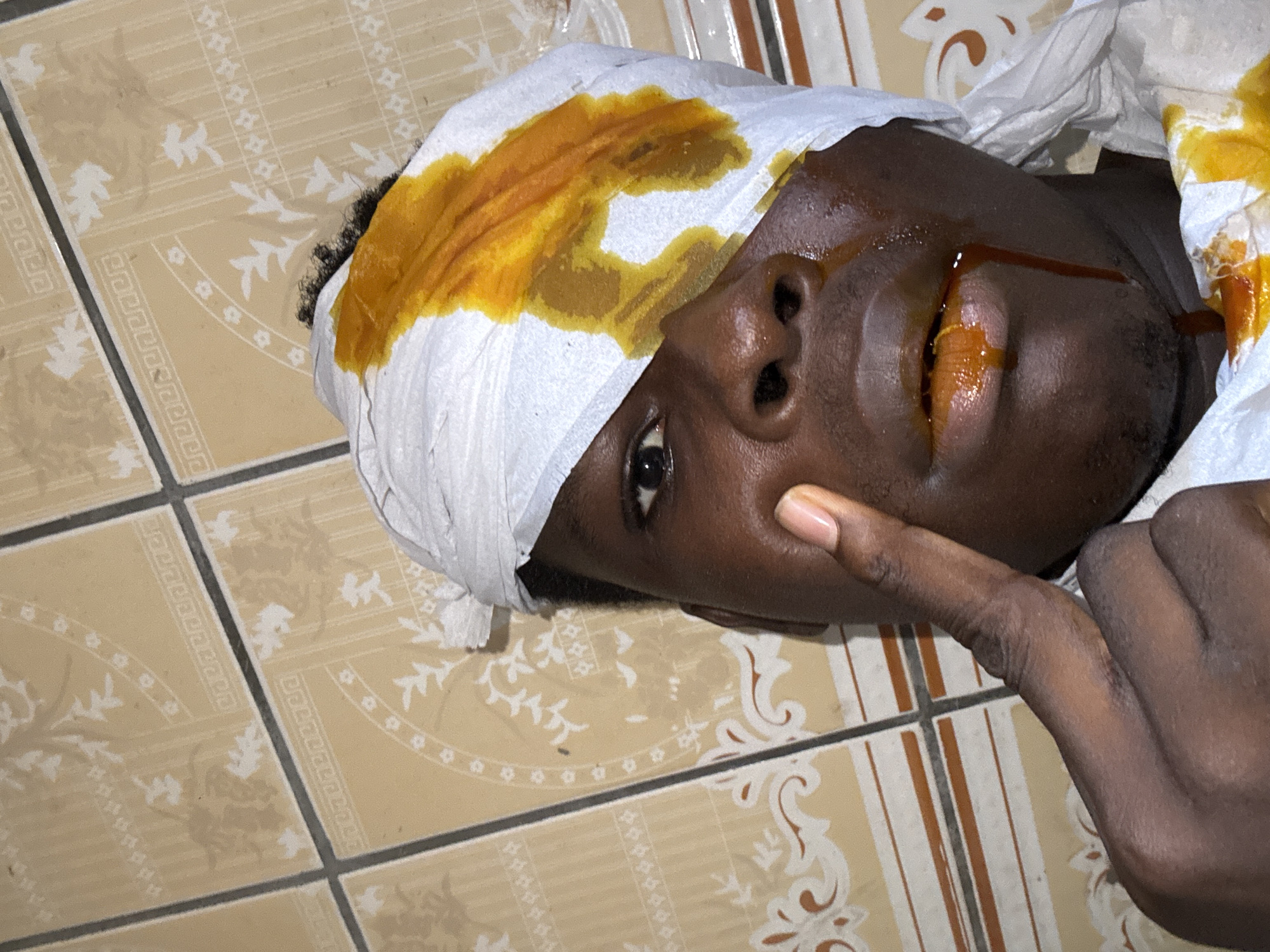 A close-up, waist-up portrait shows a Black male with a bandage wrapped around his head, stained with a bright orange substance. The bandage covers part of his forehead and eye. The man's face is tilted downwards, and he is touching his cheek with his right index finger. His lips are parted, revealing a similar orange liquid with streaks of darker liquid dripping from his mouth. The background consists of tiled walls with a decorative pattern. The image appears to have been taken indoors in what might be a residential setting in Ihiagwa, Nigeria. The lighting is artificial, casting shadows on the man's face.