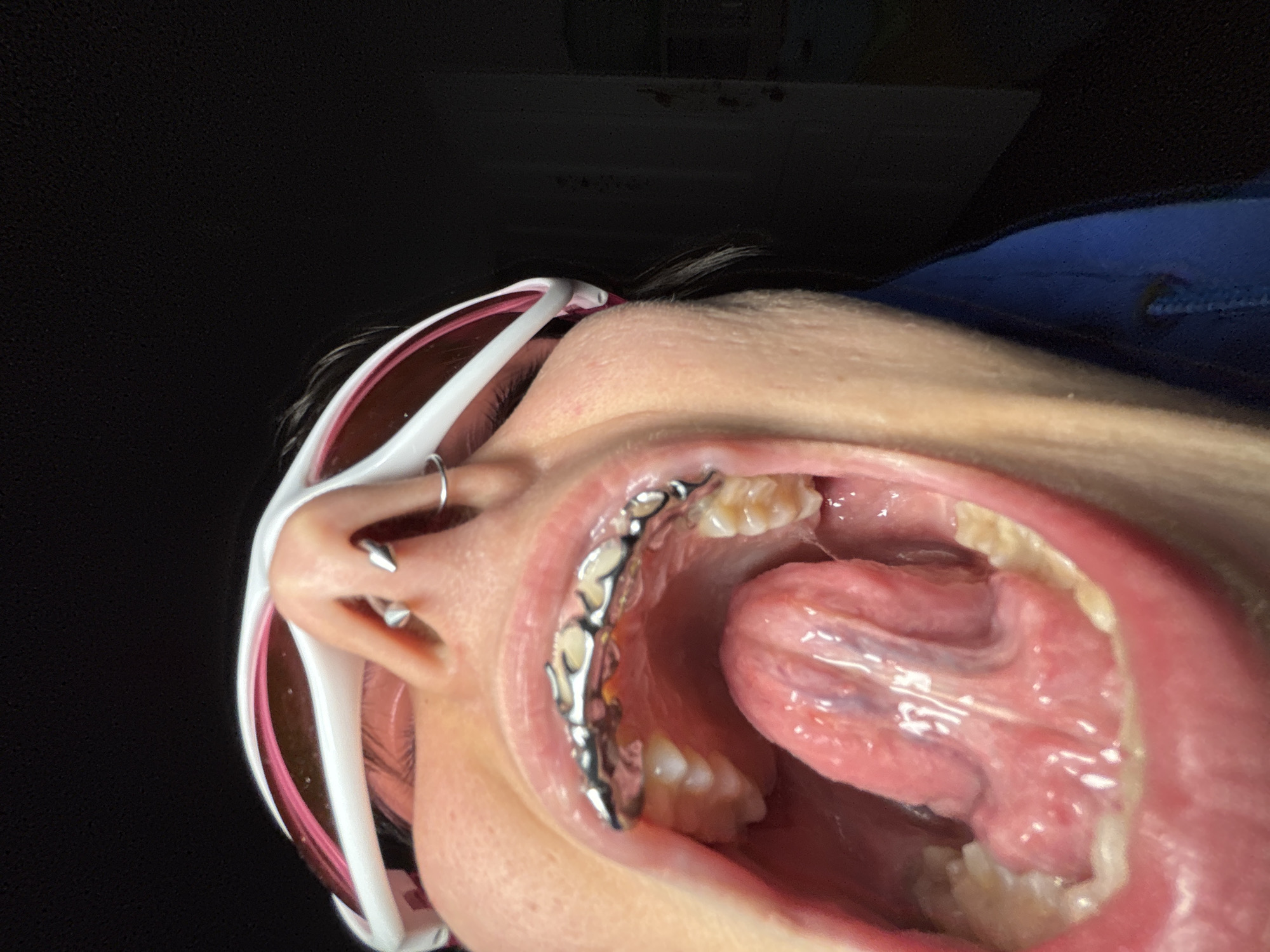 The image shows a person with their mouth wide open, revealing teeth, tongue, and a partial upper denture with metal framework. The person is wearing white sunglasses with pink trim and has two piercings in their ear. The background is black. There is no information in the image to determine the location as Sofia, Bulgaria.