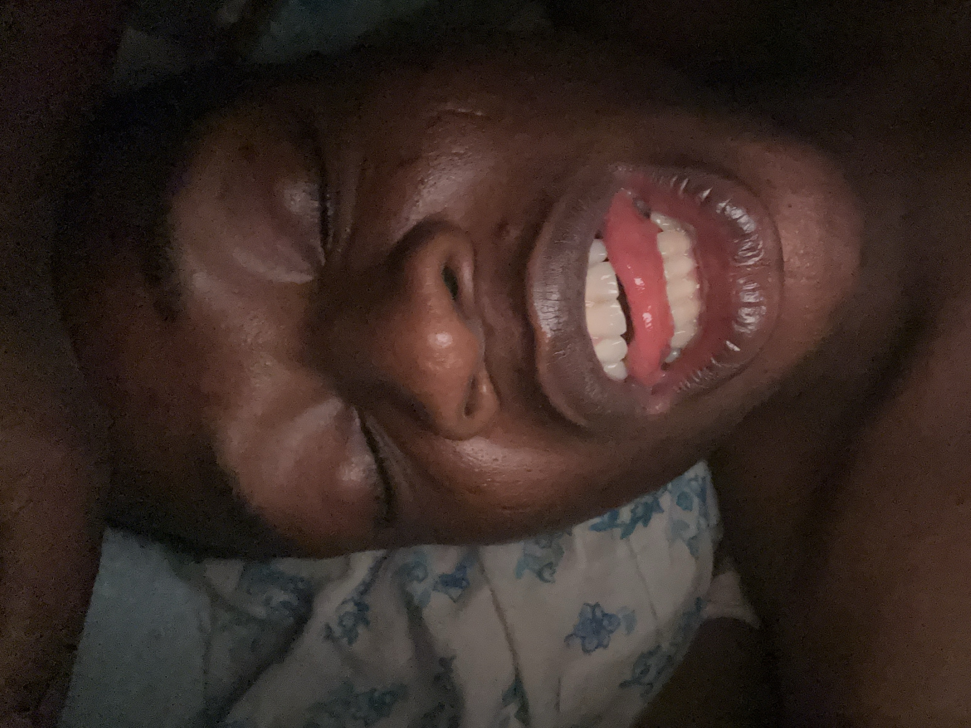 An individual with dark skin lies on a bed covered with a white and blue floral patterned sheet. The person's eyes are closed, and their mouth is open, revealing white teeth and a pink tongue. The person's face is damp, possibly with sweat.