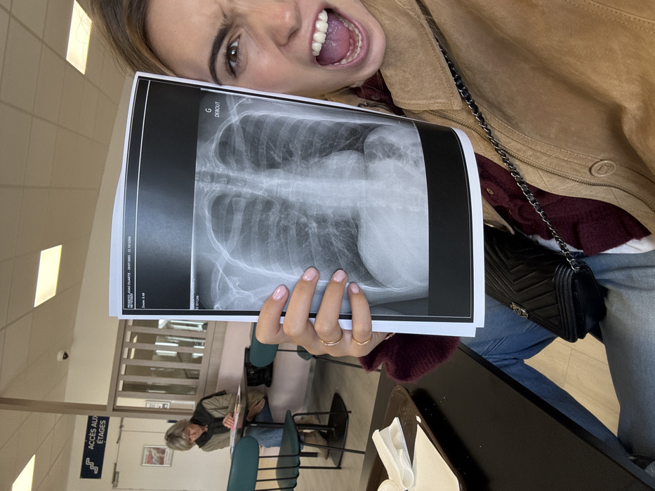 The image depicts an indoor waiting area, likely within a medical facility, located in Saint-Priest, France.
In the foreground, a young adult female's right side is visible, holding a printed chest X-ray film directly towards the camera with her left hand. She has light-colored hair, a visible right eye, and her mouth is wide open in an exaggerated expression. She wears a tan-colored jacket over a maroon top and blue jeans. A black quilted shoulder bag with a silver chain strap is visible on her left side. Her left hand has light pink nail polish and two gold rings on the ring finger. The X-ray film displays a frontal view of a human chest, with text at the top indicating "PEREIRA JOAO DUARTE - 29/07/2005 - 23:15:290", the word "DEBOUT" (French for 'standing'), and the partially visible word "DISGUT".
In the background, an older adult female with short grey hair is seated at a table. She wears a light brown jacket over a dark scarf and is observed looking down at an item on the black tabletop, possibly engaging with paperwork. She is positioned on a light pink upholstered bench, with green-backed chairs nearby.
The environment features a white ceiling with square fluorescent light panels. A small security camera is mounted on a ceiling beam. On a wall to the left, a blue sign with white arrows points upwards and reads "ACCES AUX ÉTAGES" (Access to Floors). A light-colored, vertically slatted partition separates the foreground from the background seating area. In the immediate lower-left foreground, a brown tray holds white napkins or paper on a black table.