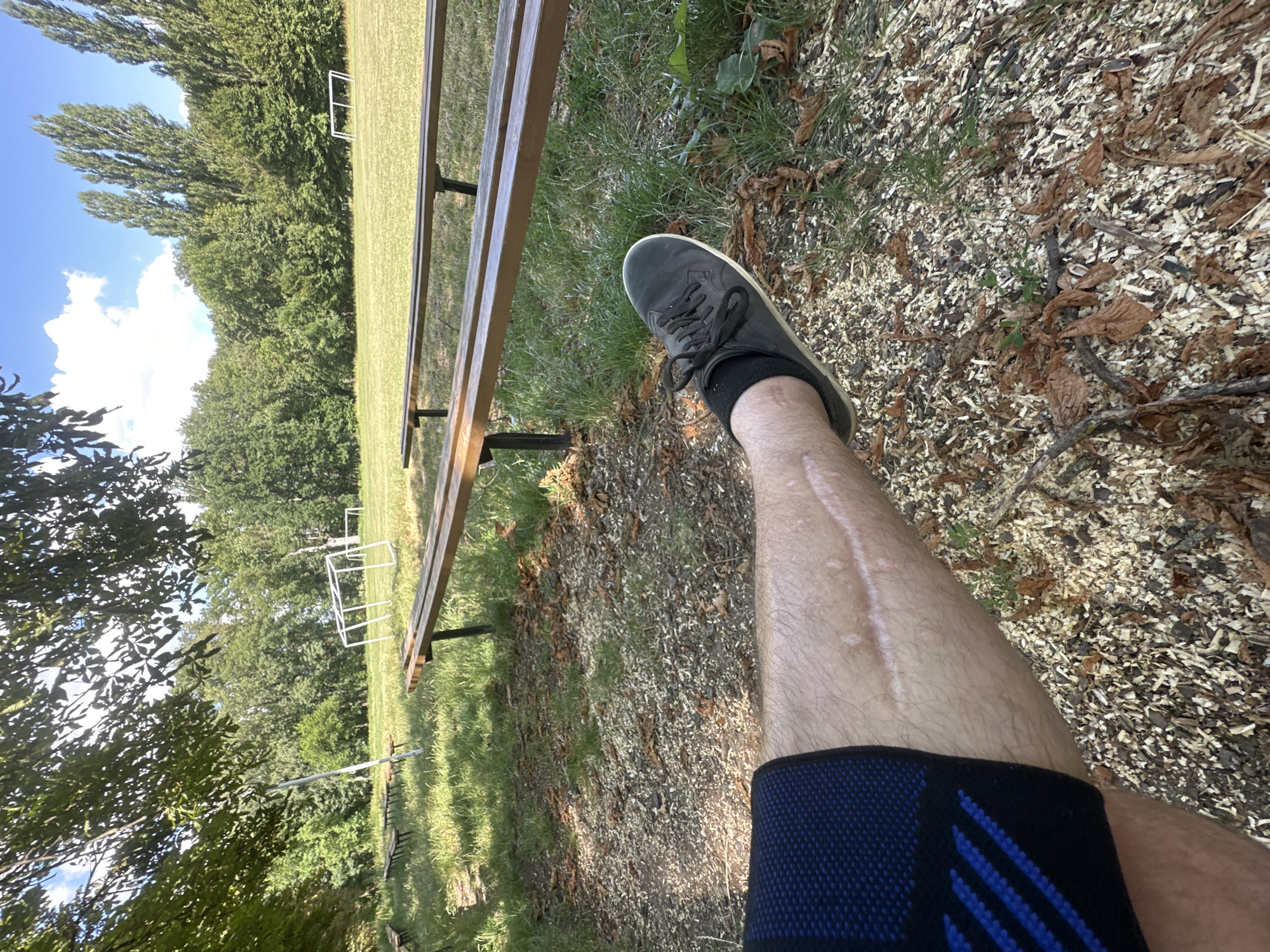 An upward-angled, medium shot captures a person's right leg and foot resting on a path covered in wood chips and fallen leaves. The leg, visible from the knee down, wears a dark blue compression sleeve with lighter blue diagonal stripes on the upper portion. A prominent, pale scar runs diagonally across the shin. The person's foot is clad in a dark gray sneaker with black laces and a black sock. The background reveals a grassy field with a few rows of wooden benches. Beyond the benches, a white soccer goal is visible, and further in the distance, a dense line of green trees forms the horizon under a bright blue sky dotted with white clouds. The setting appears to be a sports field or park area, possibly within the vicinity of Makiv, Ukraine, given the context provided.