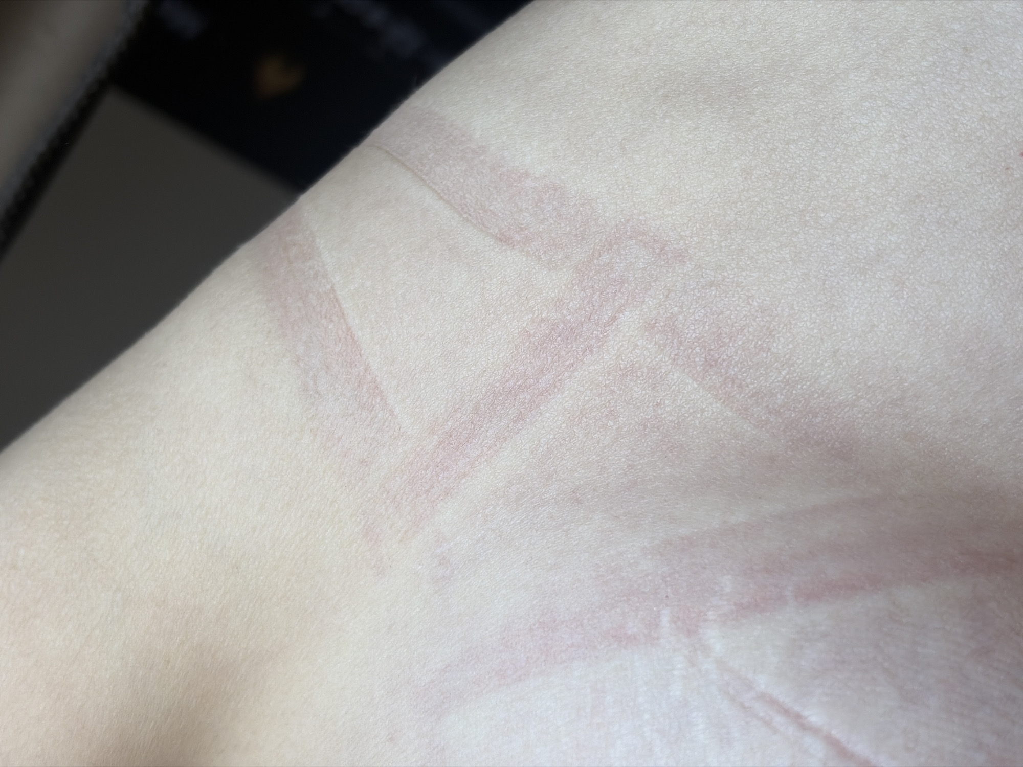 The image depicts human skin marked with reddish lines forming an irregular geometric pattern, resembling marks left by clothing or straps. The skin appears light in tone, and the lines are faded. The location and specific context cannot be determined from the image alone. There are no discernible people, actions, or environmental details visible to connect this image to Saint Petersburg, Russia.