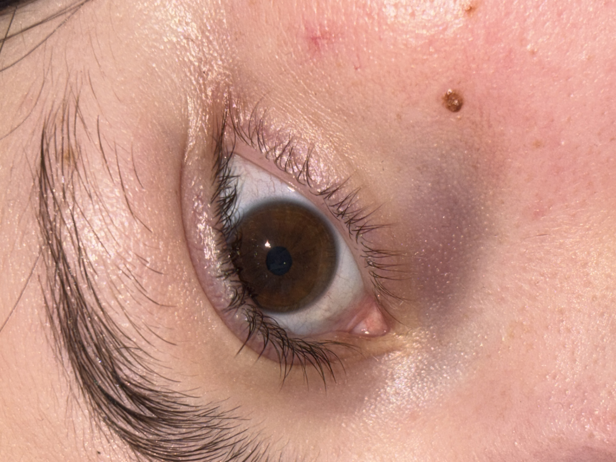 A close-up photograph depicts a human eye, specifically the left eye, with brown iris. The surrounding skin appears fair, with visible eyelashes and eyebrow hairs. A mole is present on the skin above the eyelid. A small, reddish mark can also be seen. The photograph does not provide information related to the city of Фоки, Russia.