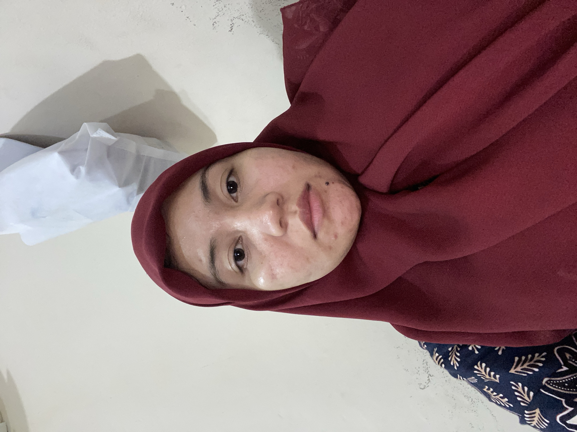 A young woman wearing a dark blue and white patterned shirt and a maroon hijab is pictured in a close-up, upper body shot against a neutral background. Her face is angled slightly towards the camera, and she has acne on her cheeks and chin. A white, crumpled object is visible hanging on the wall behind her. The image appears to be taken indoors, likely in a residential setting, possibly within the city of Banjarbaru, Indonesia, given the context provided, though no specific city landmarks or identifying features are visible in the image to confirm this location.