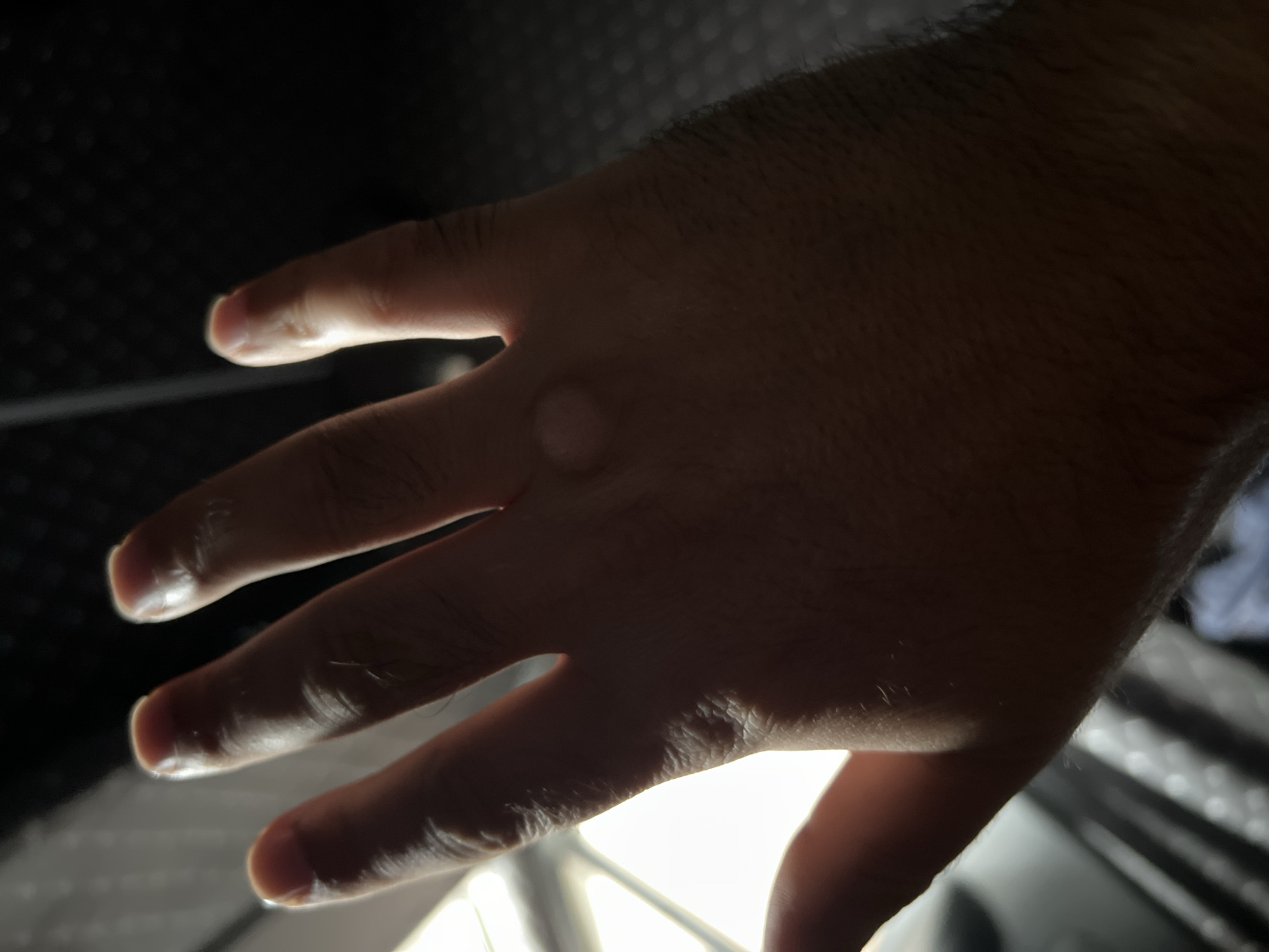 The image displays a close-up view of a person's left hand. The hand is angled with the palm facing upwards and slightly towards the viewer. The lighting is dim, with a bright light source to the left, casting shadows across the hand. The focus is on the back of the hand, where a small, raised, circular blister is visible between the knuckles of the index and middle fingers. The skin appears slightly reddened around the blister. The background is dark and blurred, with hints of a textured surface and some indistinct shapes, possibly indicating an indoor environment. There are no visible elements that would place the image in Astana, Kazakhstan.