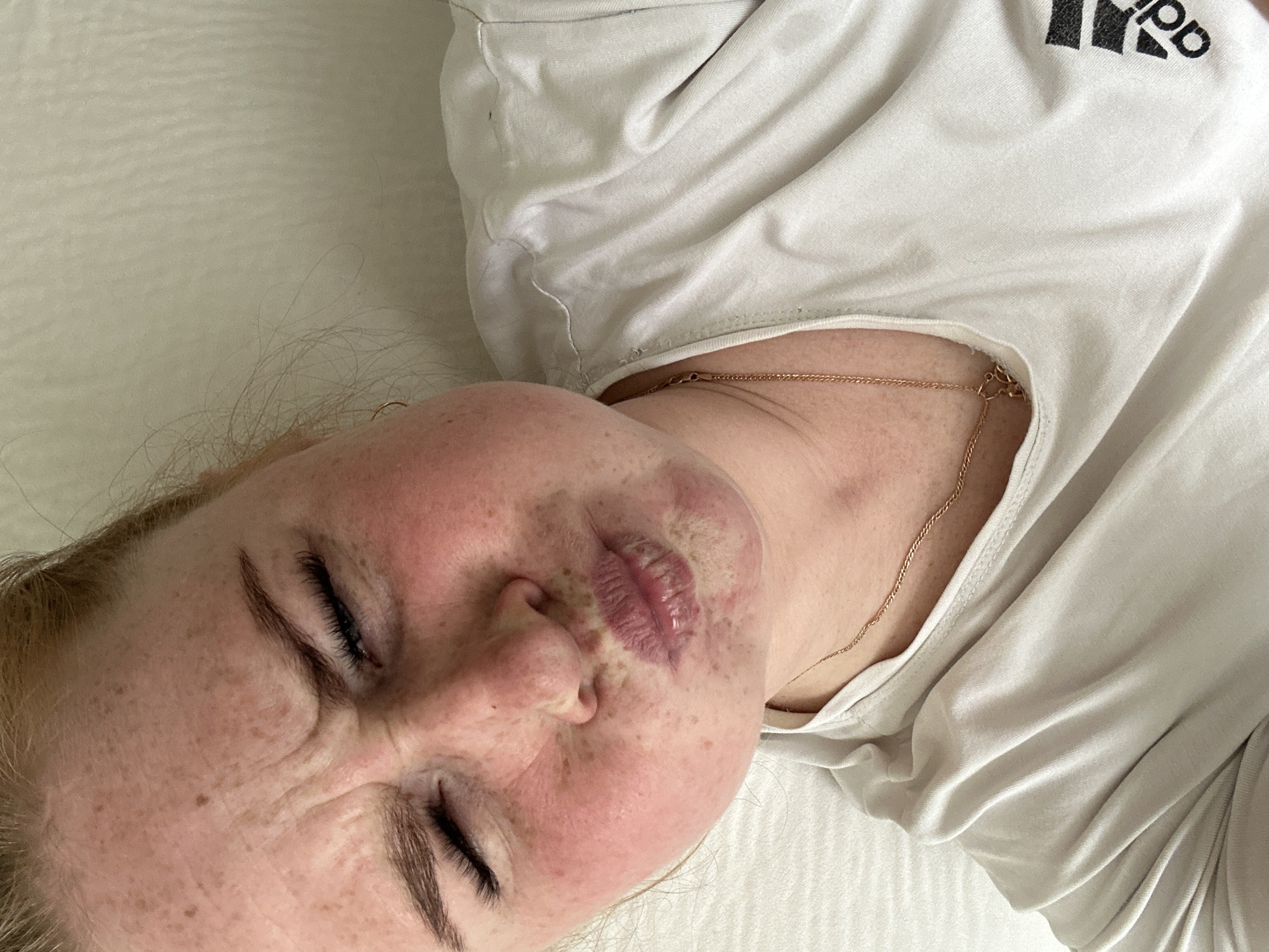 A young person with freckles is lying on a white surface, possibly a bed, wearing a white Adidas t-shirt and a gold chain necklace. The person's eyes are closed, and their face is scrunched in an expression of discomfort. There is noticeable swelling and discoloration around their lips. The image does not contain information about the location in Chaikovsky, Russia.