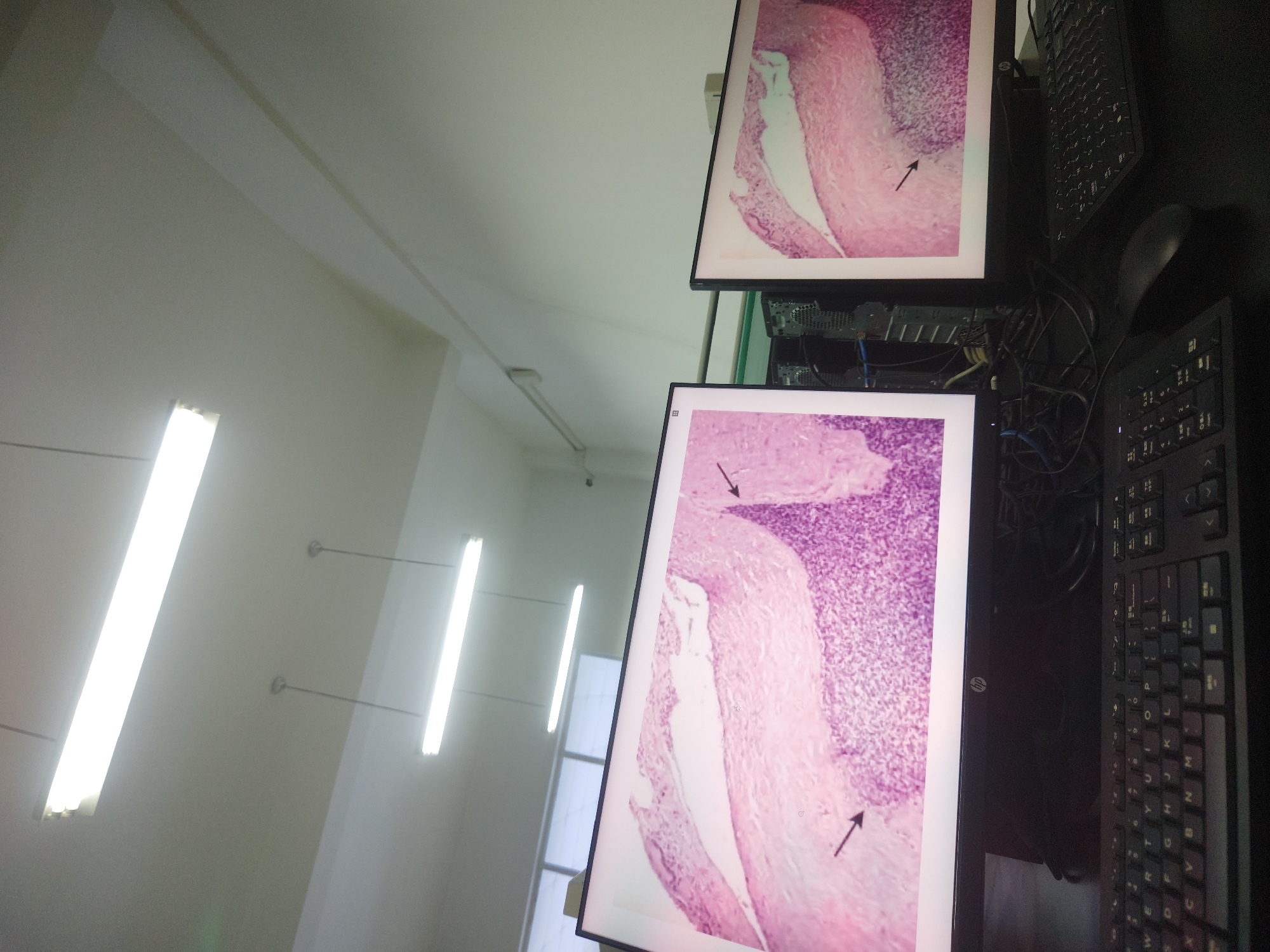 The image shows two computer monitors displaying microscopic images of tissue samples, possibly related to a medical or scientific study. Arrows are visible on the images, presumably highlighting specific features or areas of interest. To the right of the monitors are two black keyboards and a computer mouse. The monitors and computer equipment are set up in a room with fluorescent ceiling lights. The room appears to be a laboratory or office setting, potentially in the Chongqing High-tech Zone, China, but there is no verifiable information in the image to definitively confirm the location. There are no people visible in the frame, and no direct actions or interactions are depicted.