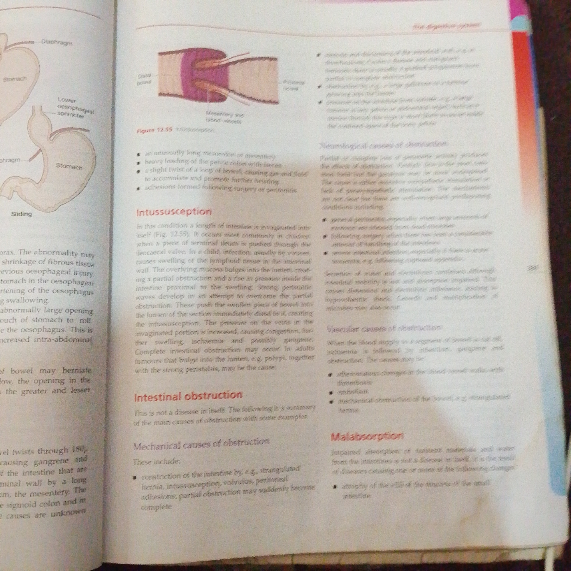The image displays two pages of a medical textbook. The left page features diagrams of the stomach and diaphragm, illustrating a "sliding" hernia. Text below the diagrams discusses conditions related to the esophagus and stomach, such as hiatal hernia and esophageal shortening.
The right page focuses on intestinal obstruction. It begins with an illustration labeled "Figure 12.55 Intussusception," showing a cross-section of the intestine where one part has telescoped into another. Subsequent text elaborates on intussusception, including its causes and consequences. Further down, sections detail "Neurological causes of obstruction," "Vascular causes of obstruction," and "Malabsorption," listing various conditions and their effects on the digestive system. The text is presented in a formal, academic style, typical of medical literature. The pages are white with black text and some colored illustrations. The lighting suggests the image was taken indoors, possibly with natural light from a window.
This image is a photograph of a medical textbook and does not depict any scene in Jalingo, Nigeria, nor does it contain any information about people, subjects, objects, actions, interactions, or the environment within that city.