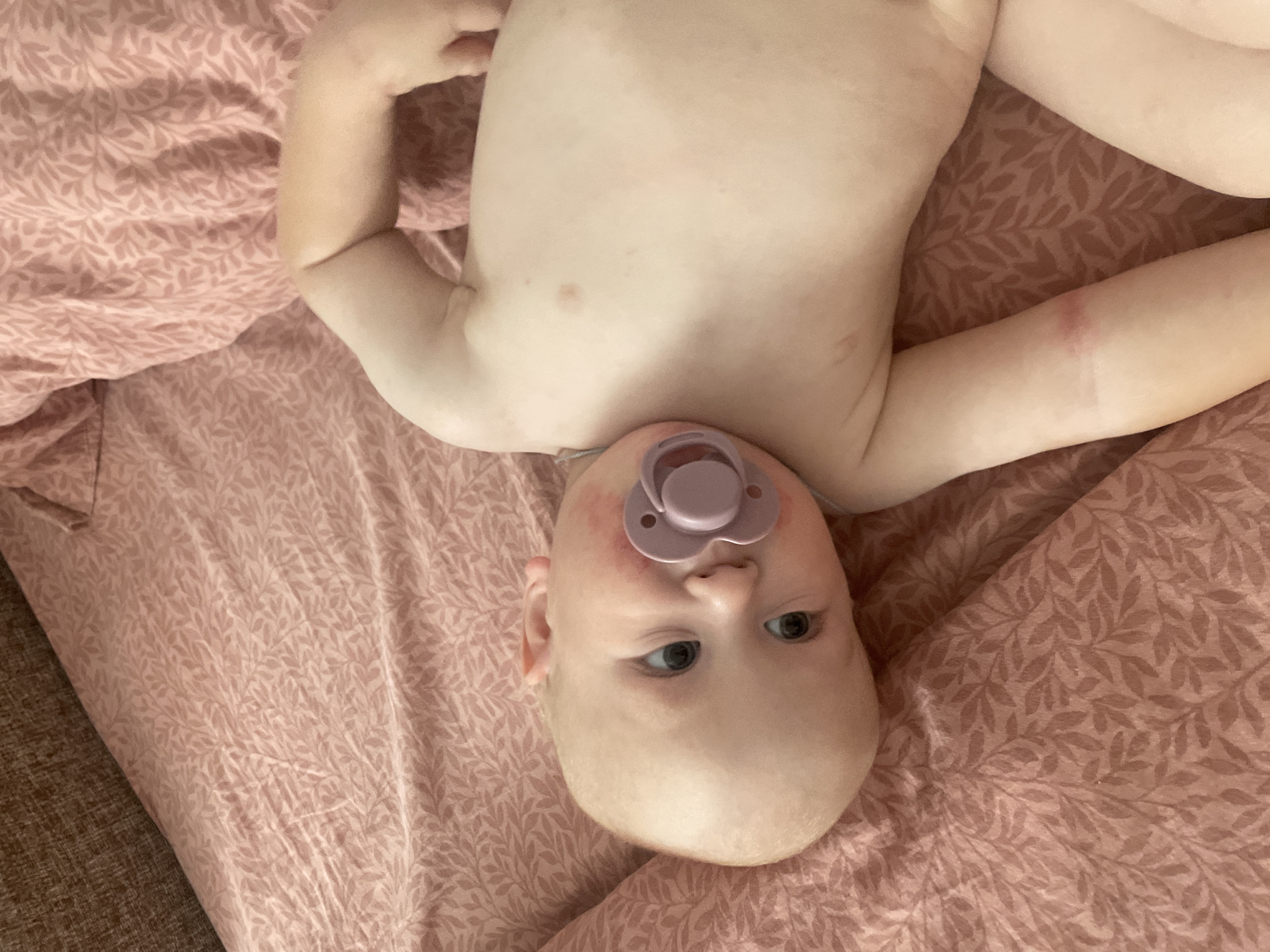The image shows a baby lying on a pink, patterned sheet. The baby is viewed from an overhead, slightly angled perspective and is mostly unclothed, with only a pacifier in its mouth. The baby's head is at the bottom of the frame, and its body extends upwards. The baby's eyes are open and looking towards the side. The skin on the baby's face appears slightly irritated around the mouth and cheek area. The background is dominated by the pink sheet with a subtle leaf or vine pattern. The lighting suggests an indoor setting, possibly during the daytime. There is no visible text in the image. The overall impression is one of a candid, close-up shot of a baby in a relaxed state.
