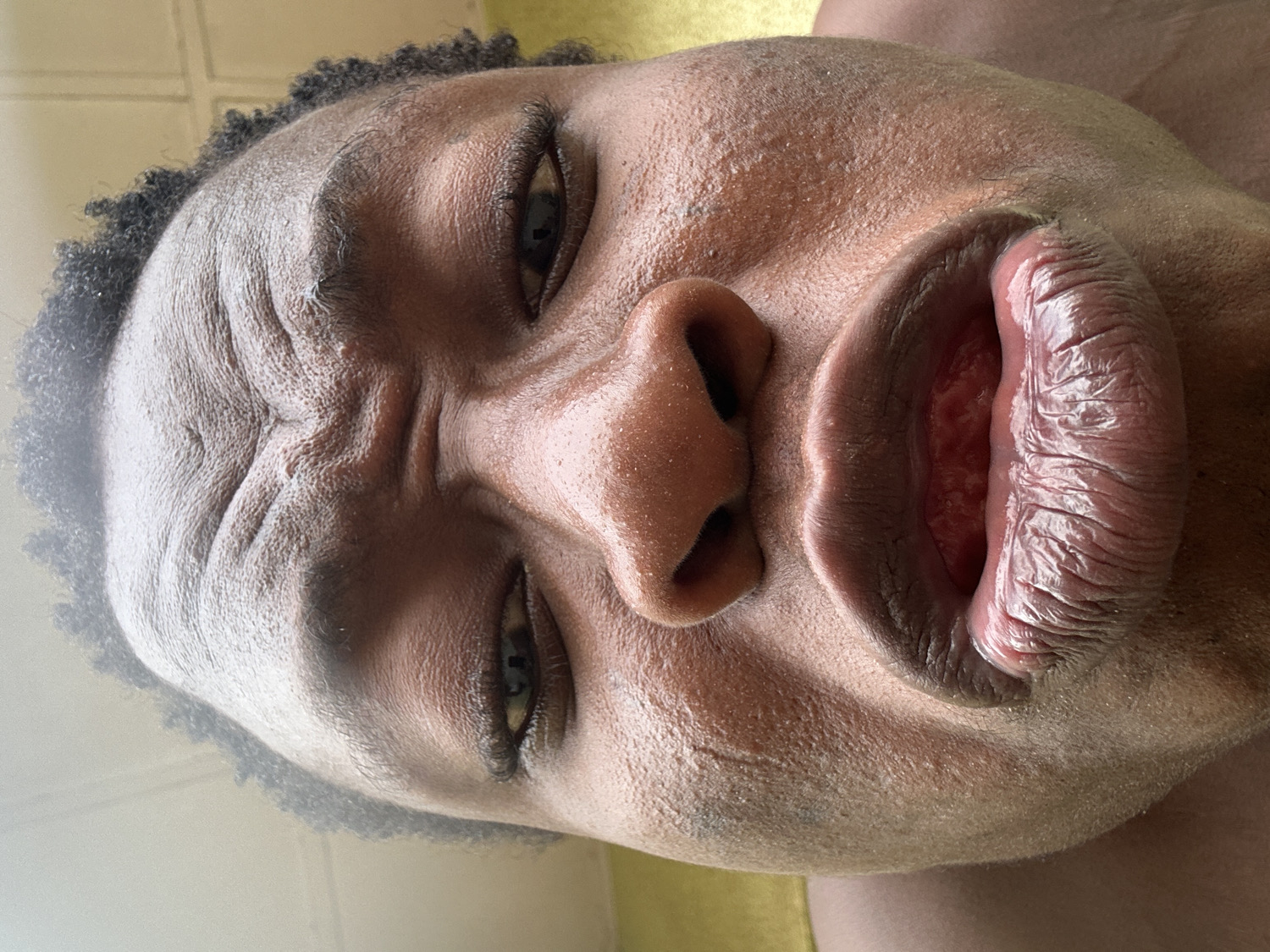 A close-up, angled portrait of a dark-skinned individual with full lips, a wide nose, and wrinkled forehead. The eyes are partially open, and the hair is short and dark. The skin appears oily and textured. The background is indistinct and out of focus. The location is Unknown, Unknown.