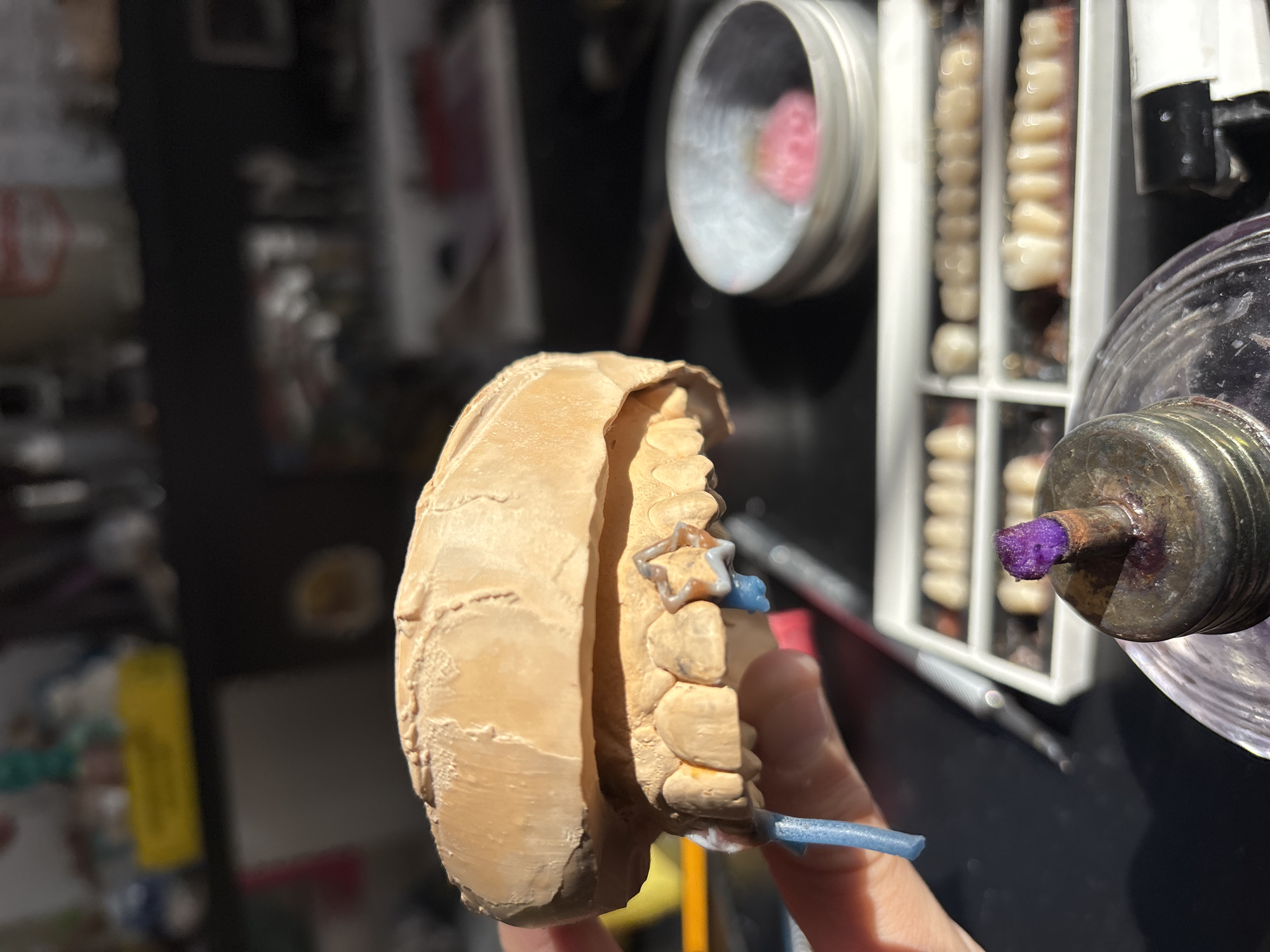 This media file captures a close-up view of a dental technician's workbench in what appears to be a dental laboratory. The primary subject is a beige-colored dental impression model of a lower jaw, held by a person's hand, with a finger visible supporting the model from below. Attached to the model are several prosthetic teeth or wax-ups, some resembling natural teeth, and a notable blue/grey star-shaped component, possibly an orthodontic appliance or a part of a dental prosthesis in fabrication. A second blue component extends from the front of the model.
In the blurred background, several objects indicative of a dental lab setting are visible. To the upper right, there is a silver cylindrical container with a distinct pink or red item inside, possibly a block of wax or a polishing compound. Below and slightly to the left of this container, a white rectangular organizer holds multiple rows of pre-fabricated prosthetic teeth. To the immediate right, a piece of dental equipment, possibly a polishing motor or a handpiece, has a purple substance on its tip, suggesting recent or ongoing work. A thin, pointed dental instrument rests on the dark surface in the middle-ground. The lighting is bright, suggesting a well-lit workspace, possibly during the daytime. No specific location cues for Sofia, Bulgaria are visible within the image, nor is there any discernible text. The image focuses sharply on the dental model and the immediate work being done, while the background elements are softly blurred.