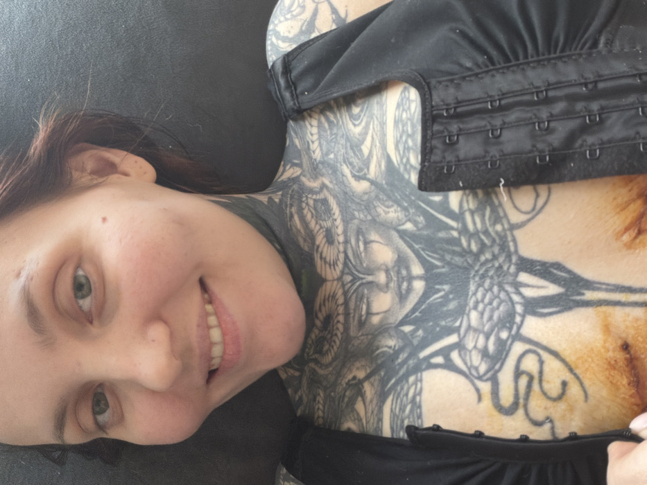 A close-up, high-angle selfie shows an adult female with fair skin, green eyes, and light brown hair, smiling directly at the camera. Her left cheek appears slightly swollen. She has extensive dark tattoos covering her neck, upper chest, and shoulders. The neck features a solid black tattoo. The upper chest displays a large, elaborate tattoo depicting a central female face resembling Medusa with snakes integrated into the design, extending across the sternum and clavicular regions, with additional snake imagery around it. She is wearing a black garment, likely a compression binder, which features a front hook-and-eye closure, partially visible and unfastened. Below the central chest tattoo, two distinct areas on her upper torso show recent surgical incisions with visible sutures and surrounding yellowish-brown discoloration. The background is an indistinct, dark, blurred surface, suggesting an indoor environment. The image does not provide any visual evidence to confirm a location in Chaikovsky, Russia.