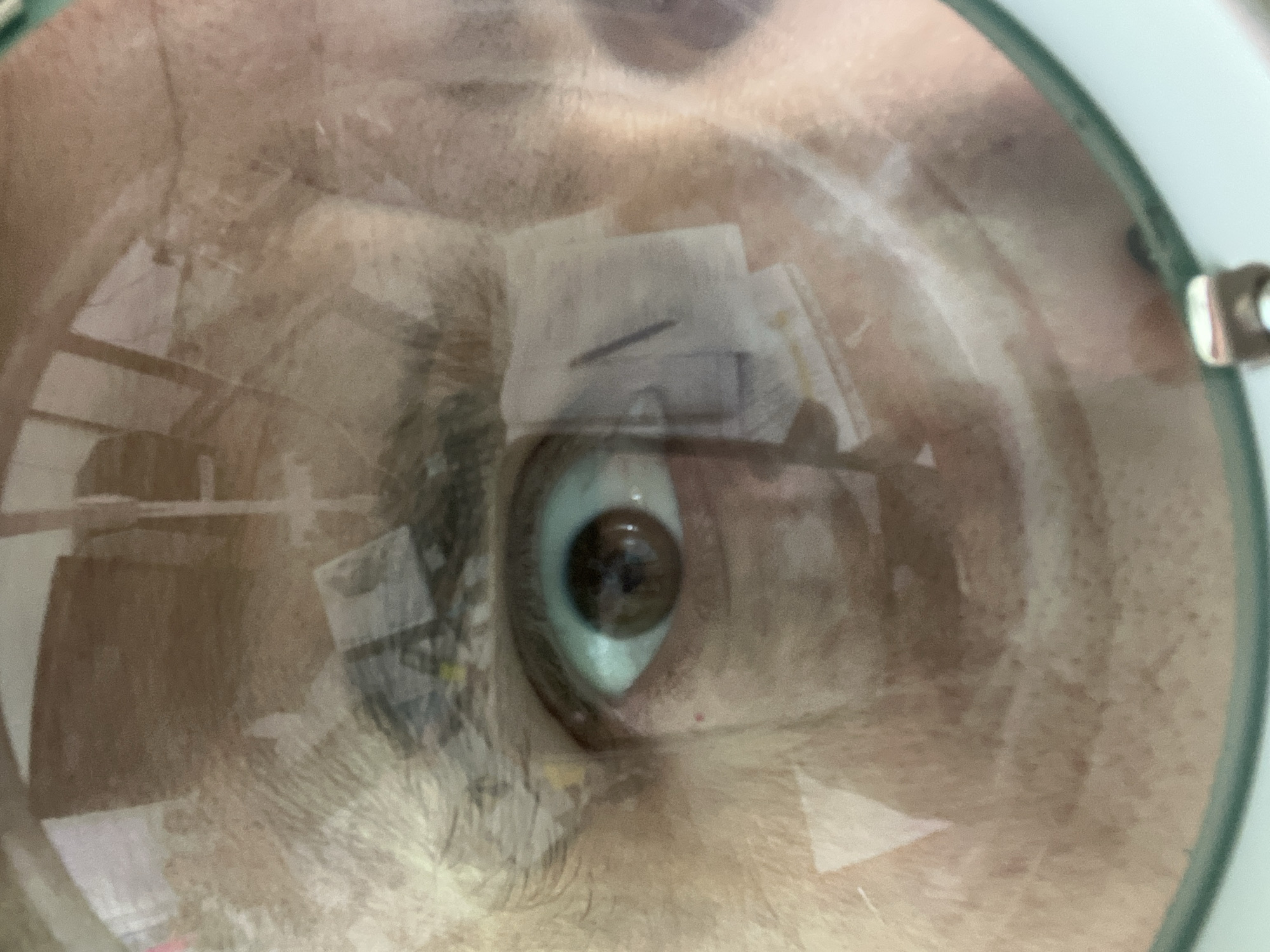 A close-up photograph depicts a human eye examined through a magnifying glass. The iris is light blue-green with a visible dark pupil. Eyelashes and skin are visible around the eye. There are bandages and other items on the face, visible through the magnifying glass. The environment appears to be indoors and is out of focus. There is no specific information from the image itself to indicate a location in Chaikovsky, Russia.