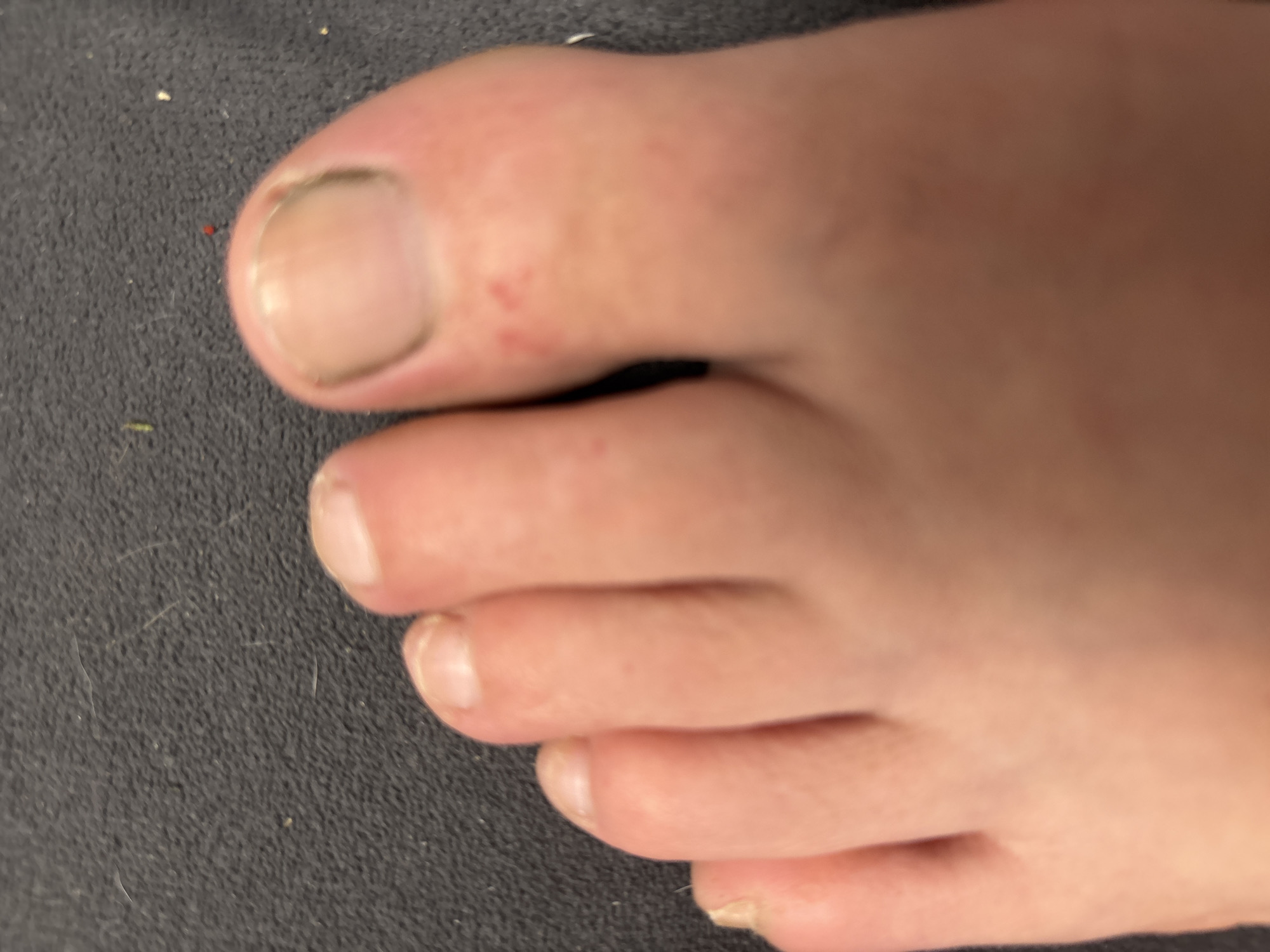 The image shows a close-up of a human foot with five toes, resting on a dark gray textured surface. The big toenail has a discolored edge. There are small red spots on the skin above the big toe. The other toes have relatively short nails. The environment appears to be a textured surface, possibly fabric. The location is not identifiable from the provided image. No people, subjects, objects, actions, or interactions are readily determinable from this image aside from the details described. The picture does not reveal its location in the city of Tolyatti, Russia or any other location.