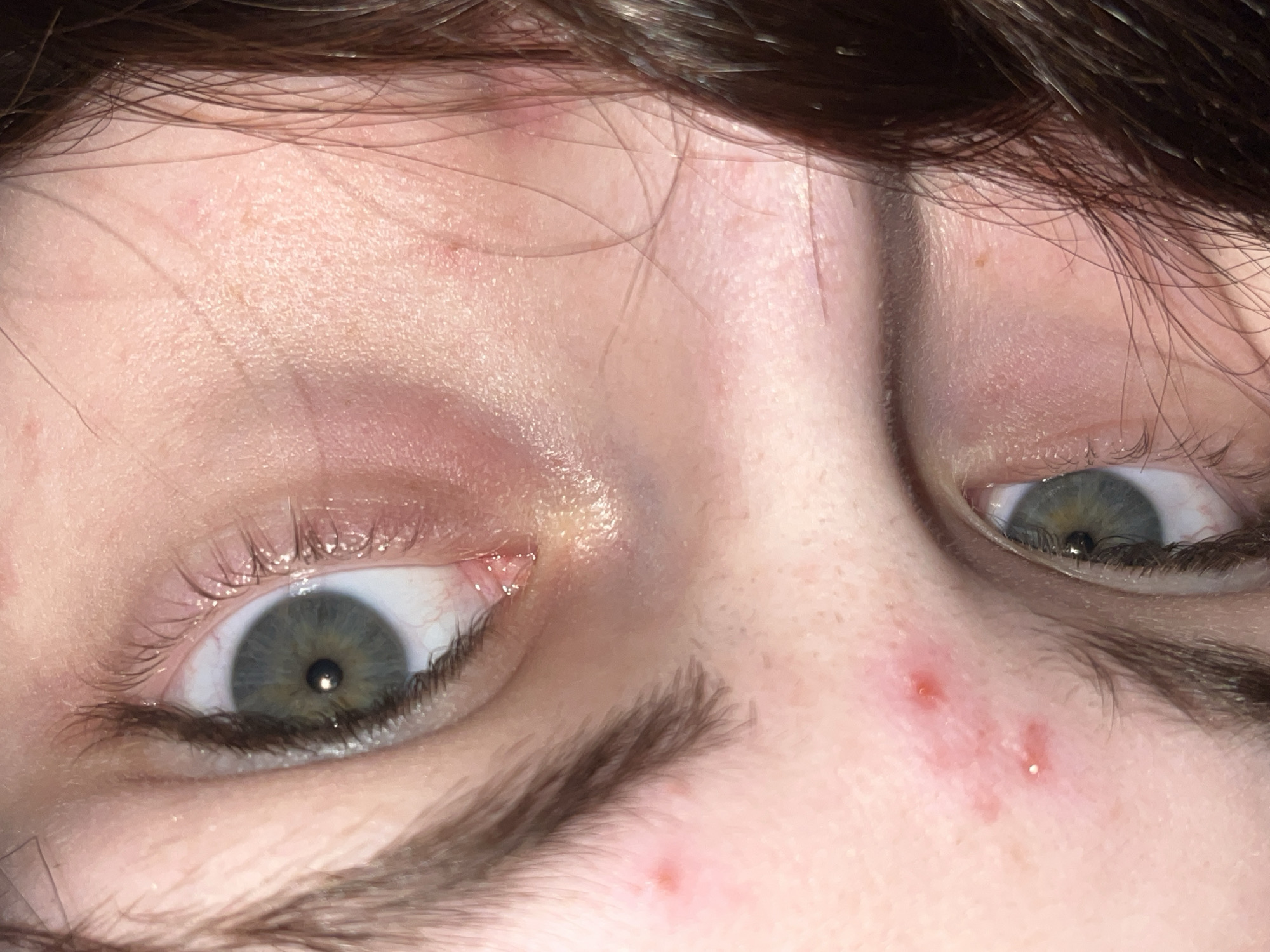 The image is a close-up of a person's face, focusing on the area around their eyes. The person has fair skin, brown hair, and light-colored eyes (possibly green or hazel). There are a few blemishes or pimples visible on the skin near the right eye. The environment is not discernible, and there is no information to suggest the location is Saint Petersburg, Russia.