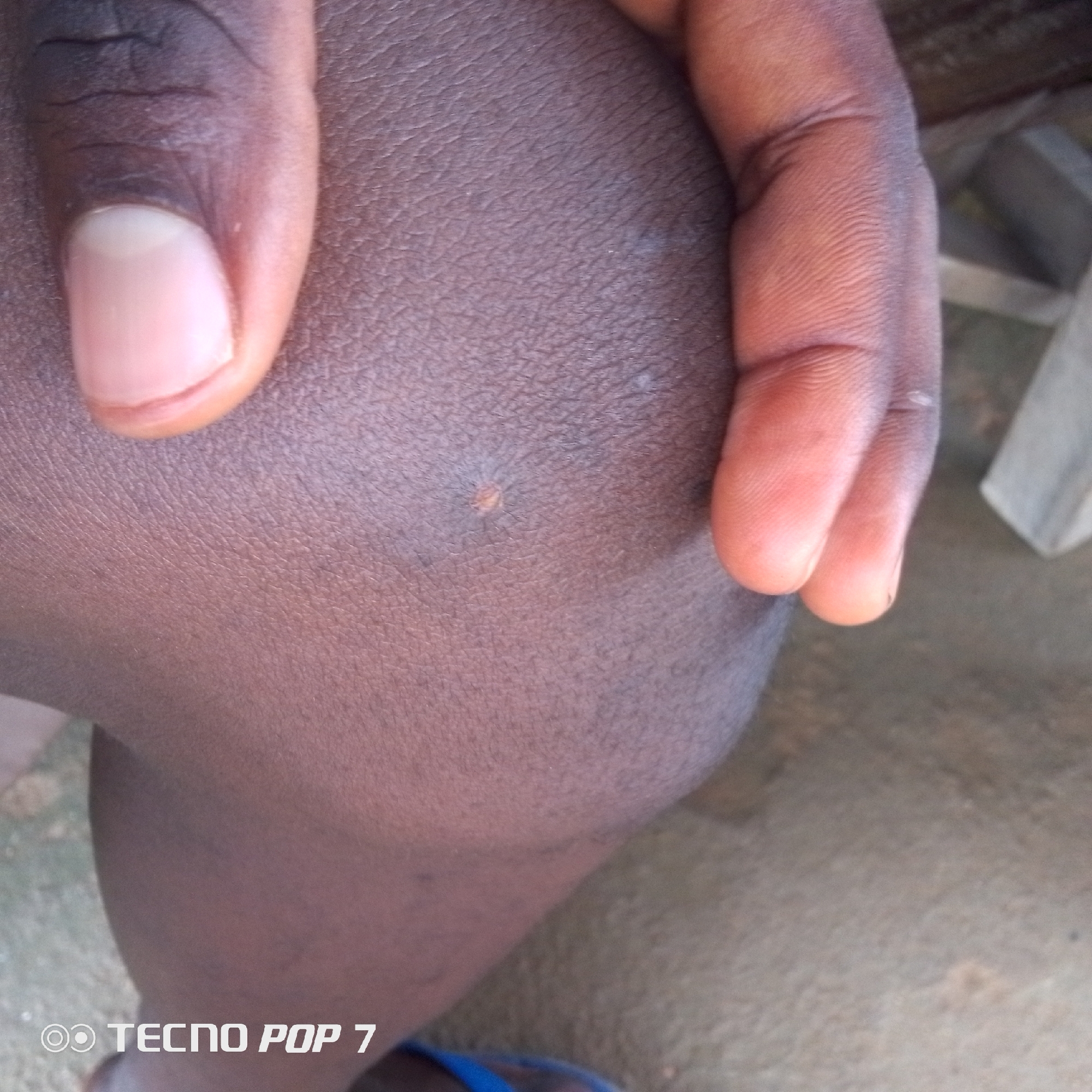 The image is a close-up, eye-level shot of a person's knee, with fingers resting on it. The skin is dark brown and textured, with some light-colored pores or small blemishes visible. A light-colored, slightly raised mark is present on the knee, possibly a small scar or healed injury. Two fingers, one with a visible fingernail, are seen in the upper left of the frame, appearing to press down on the knee. Another set of fingers is visible in the upper right, also touching the skin. The background is out of focus and appears to be a dirt or gravel surface with some indistinct wooden objects. The bottom right corner of the image contains a watermark that reads "TECNO POP 7". The scene is unspecific to any particular location within a city.