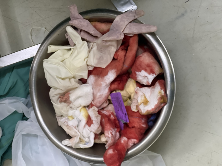 A stainless steel medical basin, approximately 35 cm in diameter, is centrally positioned, containing an assortment of used medical materials. The basin holds numerous crumpled gauze pads, heavily saturated with red blood and some exhibiting yellow-brown discoloration. Interspersed are several used medical gloves; some are cream-colored, while others are translucent pinkish-purple, with many displaying bloodstains. A small, rectangular purple plastic packaging fragment is visible amidst the soiled items. The basin rests on a light-colored surface, possibly a floor or table, which exhibits multiple dark linear scratches and scuff marks. In the upper background, crumpled green and translucent white medical textiles are present, along with the metallic edge of what appears to be a surgical tray or table. No individuals are depicted. The environment suggests a clinical or hospital setting within Nairobi, Kenya.