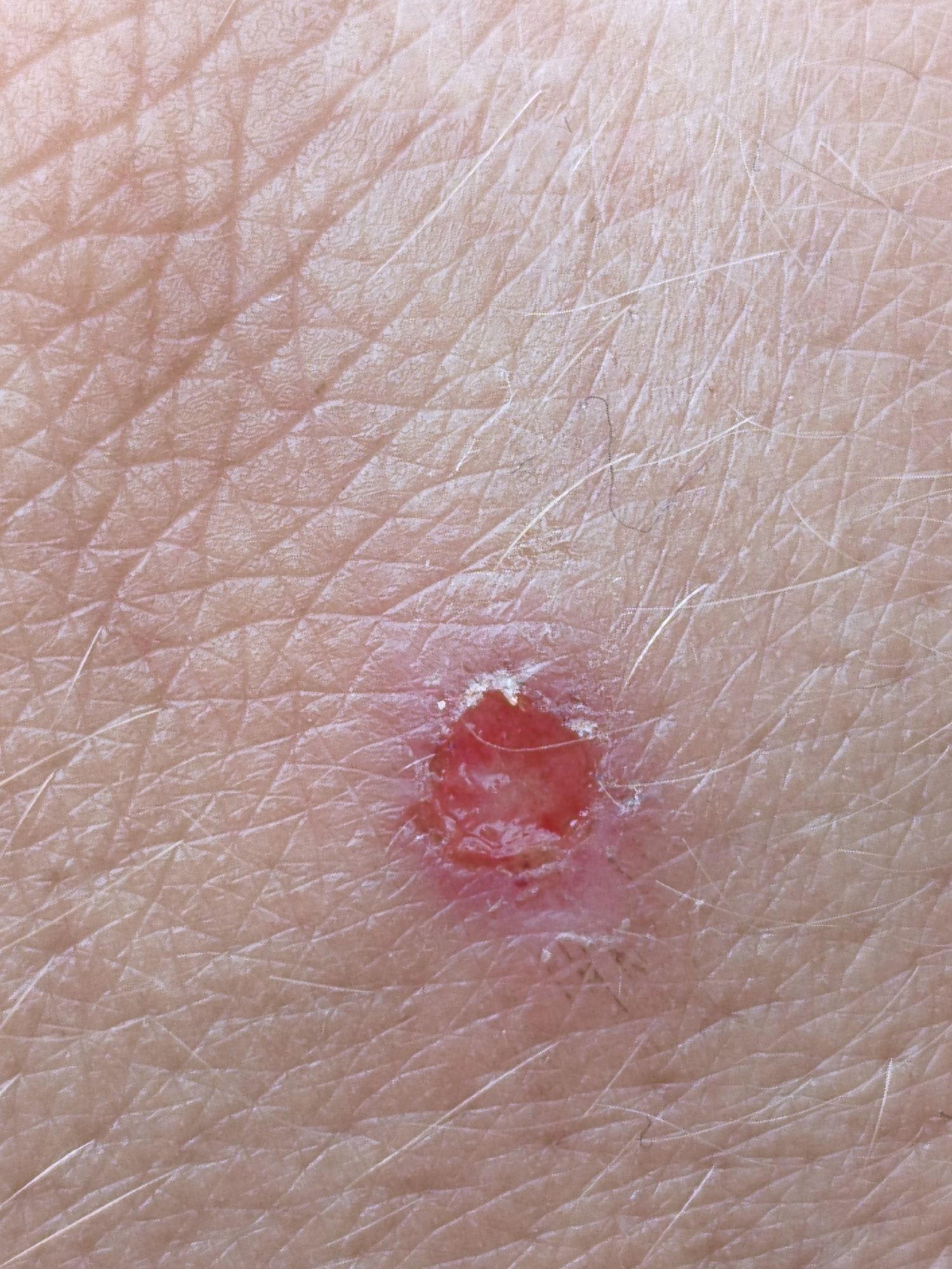 A close-up, high-angle shot shows a wound on human skin. The wound is circular with irregular edges and appears to be a shallow abrasion or scrape. The center of the wound is a bright red, moist area, surrounded by lighter pinkish-white skin that shows signs of healing or irritation. Fine, light-colored hairs are visible across the skin's surface, which has a textured, creased appearance typical of human skin. There are no other discernible features or environmental elements visible in the image. The location in Orenburg, Russia, is not visually indicated.