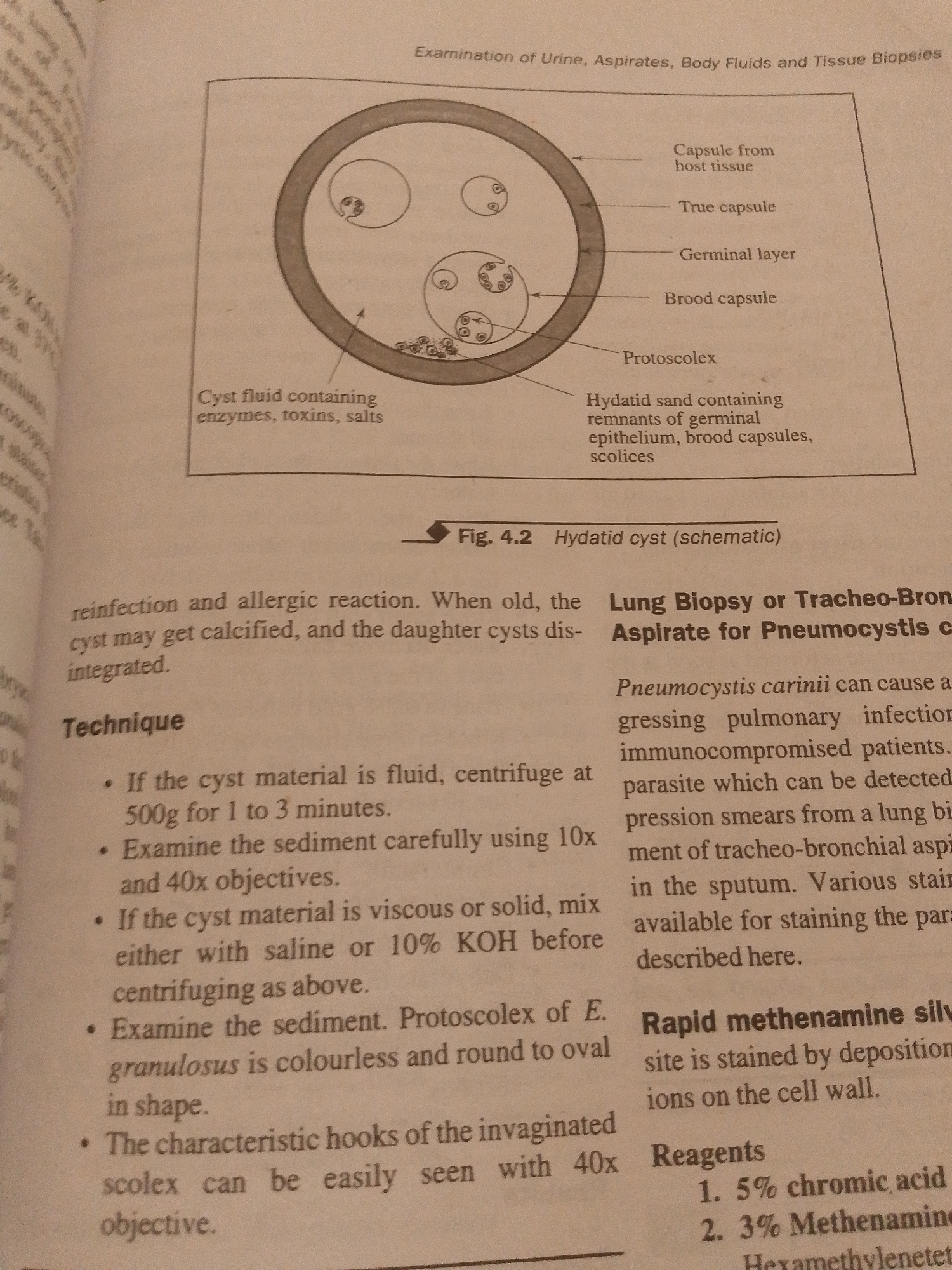 The image shows a page from a textbook with a diagram and text related to medical conditions. The diagram, labeled "Fig. 4.2 Hydatid cyst (schematic)," illustrates the structure of a hydatid cyst, with labels pointing to different parts such as the capsule from host tissue, true capsule, germinal layer, brood capsule, protoscolex, and cyst fluid containing enzymes, toxins, and salts. The text below the diagram discusses reinfection and allergic reactions related to cysts.
To the right of the diagram, there is a section titled "Lung Biopsy or Tracheo-Bronchial Aspirate for Pneumocystis carinii," which describes Pneumocystis carinii as a pathogen causing pulmonary infections, particularly in immunocompromised patients. It mentions detection methods using smears and sputum analysis.
Further down, a section titled "Rapid methenamine silver" describes a staining method. Below this, a "Reagents" section lists "1. 5% chromic acid" and "2. 3% Methenamine."
The left side of the image contains text that appears to be from a previous page or section, with fragmented sentences and references to "examinations" and "cyst."
There is no information within the image that relates to Jalingo, Nigeria, or any forensic details of a scene. The content is purely informational, pertaining to medical diagrams and diagnostic procedures.