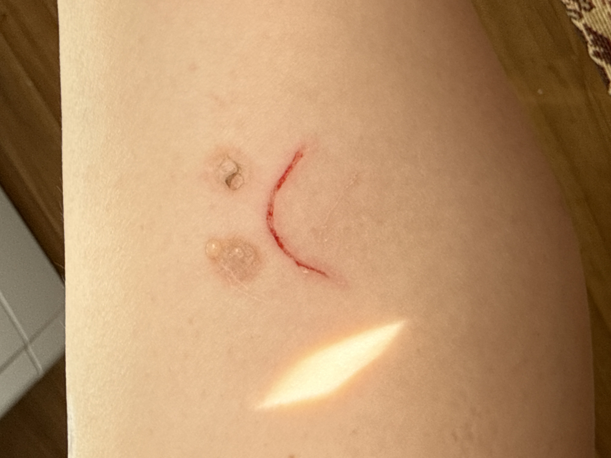 The scene depicts a close-up view of human skin, consistent with a limb. The location is in Saint Petersburg, Russia. The skin is pale, exhibiting typical epidermal texture.
Dominating the central area of the image are three distinct cutaneous markings arranged to form a "sad face" motif. Two superior, approximately circular lesions serve as "eyes." The left lesion, roughly 0.5 cm in diameter, presents as a raised, yellowish-pink blister or scab. The right lesion, slightly smaller, appears as a dark brown scab with surrounding erythema. Inferior to these, a single curvilinear laceration, approximately 3.5 cm in length, forms an inverted arc, representing the "mouth." This laceration is superficial, characterized by a sharp, thin red line with visible blood or serous fluid along its edges, indicative of a recent injury.
A prominent, elongated streak of bright white light is reflected on the mid-left portion of the skin, suggesting a direct illumination source.
The background is largely out of focus. The upper part reveals a dark brown, possibly wooden, surface immediately above the skin, topped by a lighter grey surface with faint horizontal lines, resembling wall tiles or a ceiling. The lower right portion of the image shows a blurred section of patterned fabric, predominantly yellowish-brown with darker accents, consistent with upholstery or a rug. No individuals are fully visible, and no direct actions or interactions beyond the skin markings are depicted.