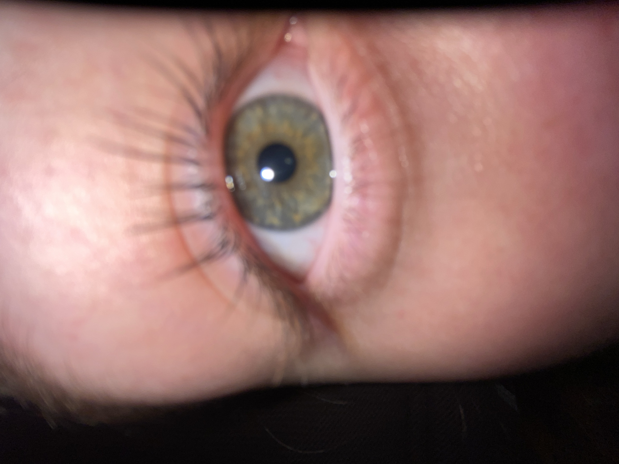 A close-up image of an eye, with green and brown iris, and black pupil. The surrounding skin is light pink. Eyelashes are visible, and the background is dark. The location is Unknown, Unknown.