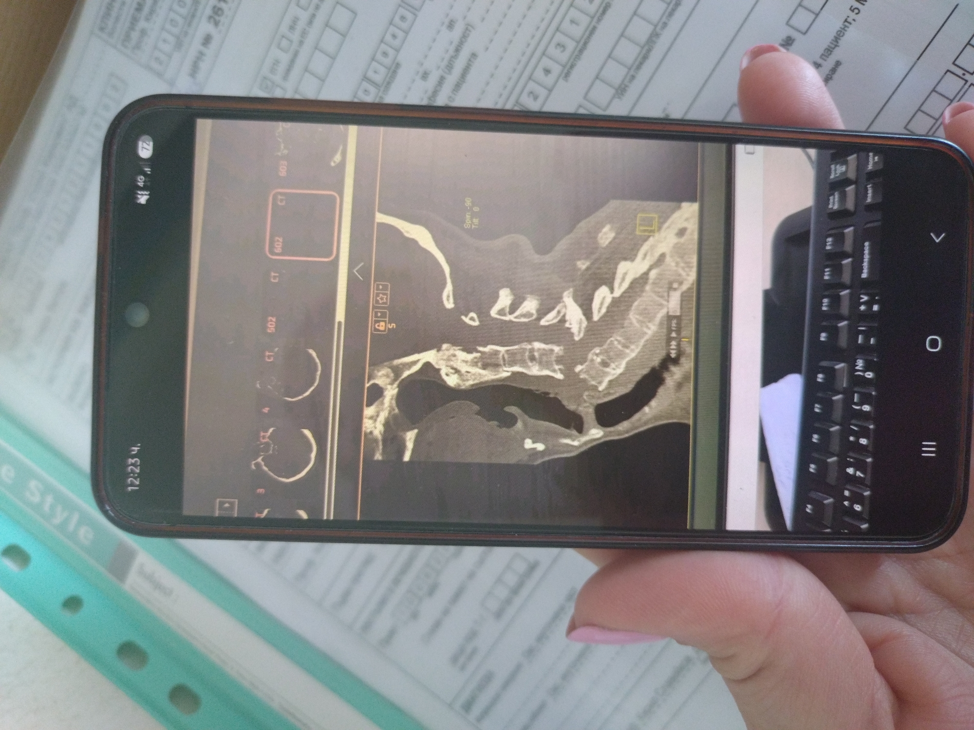 The image shows a close-up of a person's hand holding a smartphone. The smartphone screen displays a medical image, specifically a CT scan of a human spine and neck area. The phone's status bar indicates the time is 12:23, and there is a 4G signal with battery indicator. The background appears to be medical or administrative documents, with some text visible in what looks like Bulgarian. The overall scene is an indoor setting, likely a clinic or office, given the documents and medical imagery. There is no discernible information about the location within Stara Zagora, Bulgaria, or any specific actions or interactions beyond the person holding the phone.