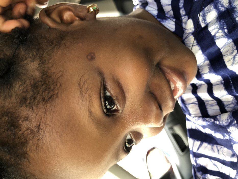 A close-up image features a young child with dark skin, smiling broadly and looking slightly downward and to the left. White teeth are visible in the smile. A dark, circular mark is present on the right temple area of the face. Small white bumps are visible on the bridge of the nose and below the left eye. The child has short, dark, curly hair. A gold-colored hoop earring with a green accent is worn in the right earlobe. A hand with a dark skin tone is partially visible at the upper right, near the child's head. The child is wearing a garment patterned with blue and white stripes in a tie-dye or batik style. The background is out of focus, displaying indistinct shapes and reflections consistent with the interior of a vehicle. While the provided context indicates the city of Ilishan, Nigeria, the specific location within the city is not discernible from the visual evidence in the image.