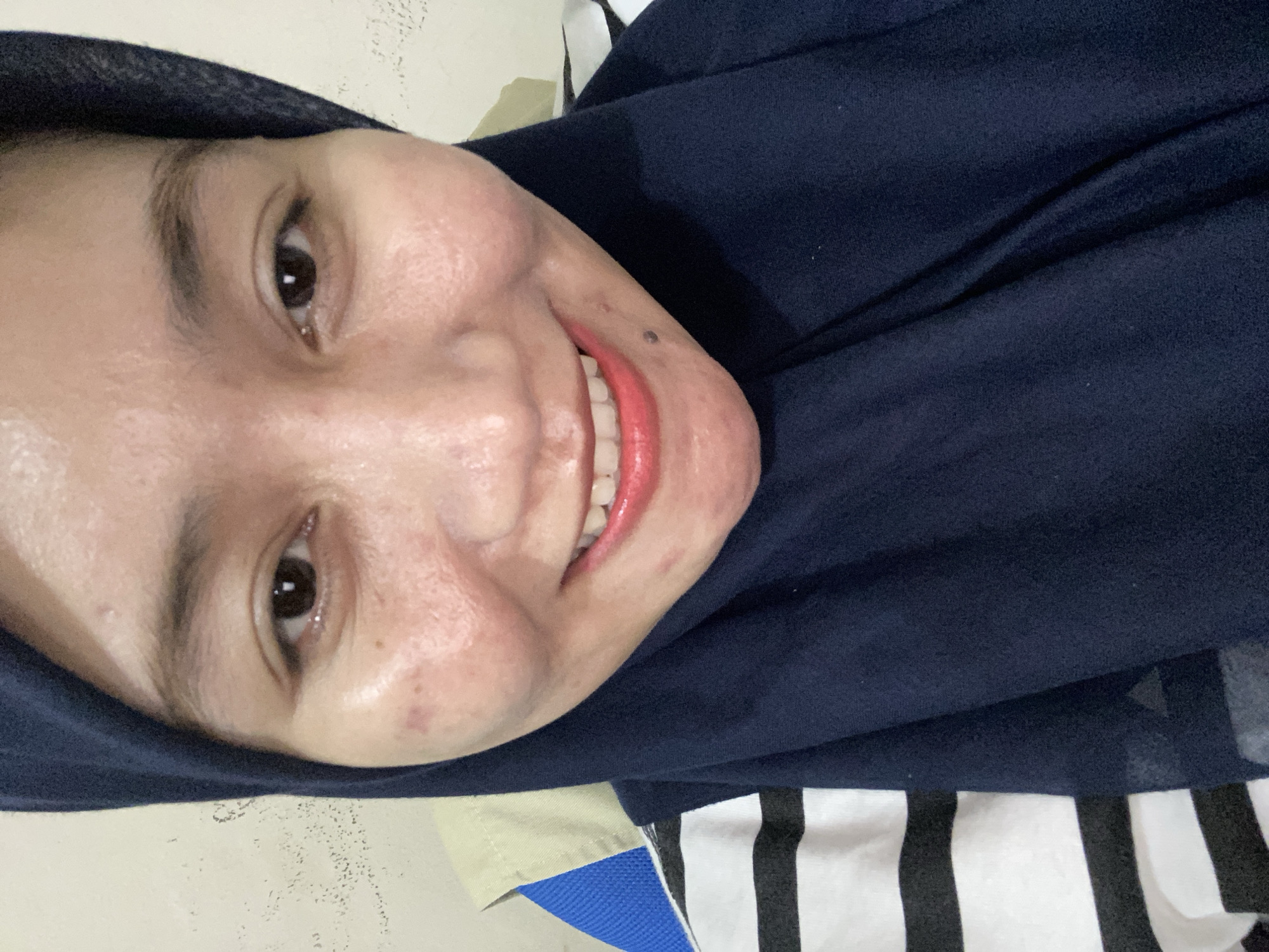 A woman, wearing a dark blue hijab and a black and white striped shirt, is shown in a close-up, upper-body portrait. She has fair skin with visible blemishes, including acne and redness, particularly on her cheeks. Her eyes are dark brown, and she is smiling, revealing white teeth and pink lipstick. A small, dark mole is visible on her chin. The background appears to be an indoor setting with a textured, light-colored wall and a hint of a beige and blue garment behind her. The image appears to be taken with a handheld device, possibly a smartphone, at a close range. No specific location within Banjarbaru, Indonesia, can be identified from the visual information provided.