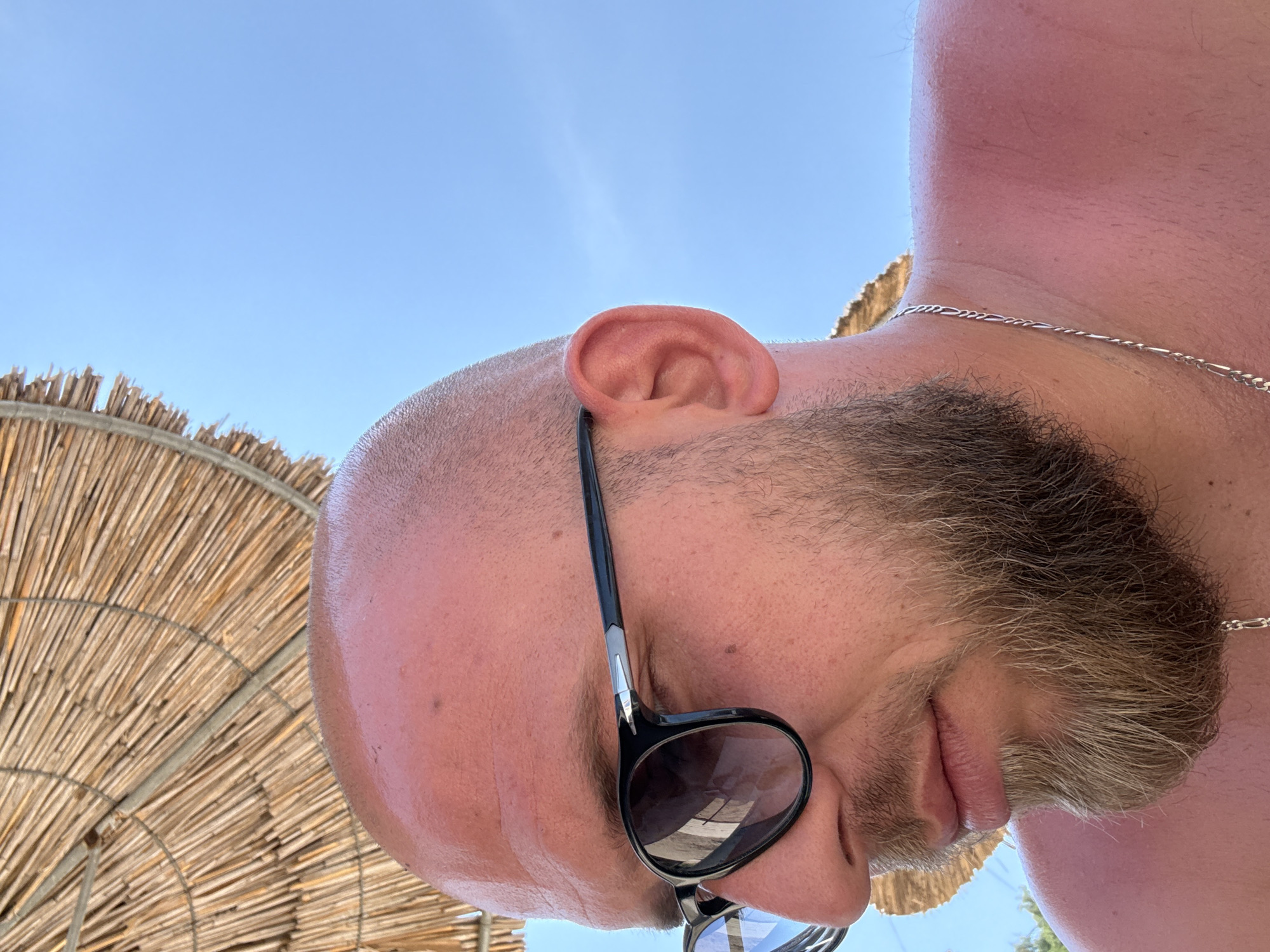 A man is pictured in a close-up shot, his face turned to the side. He is bald and has a beard, wearing dark-rimmed sunglasses. His skin appears flushed, suggesting he may have a sunburn. Behind him, a straw umbrella provides shade, and a bright blue sky is visible. The scene suggests he is outdoors, likely at a beach or resort area in Sithonia Municipal Unit, Greece.