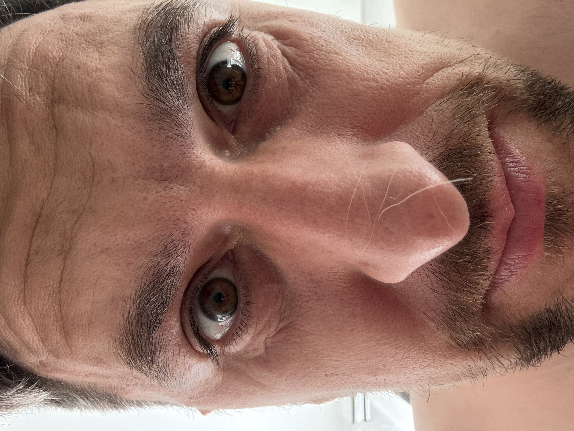 A close-up, headshot photograph focuses on the face of a light-skinned male with brown eyes, dark brown hair, and a mustache/goatee. The perspective is an unusual upward angle, capturing the face primarily from the nose up. The man's eyes are wide and somewhat glossy. Wrinkles are visible around the eyes and on the forehead. A stray white hair is present on the nose. The background is indistinct and appears to be white, possibly a wall or ceiling. The location and city are unknown.